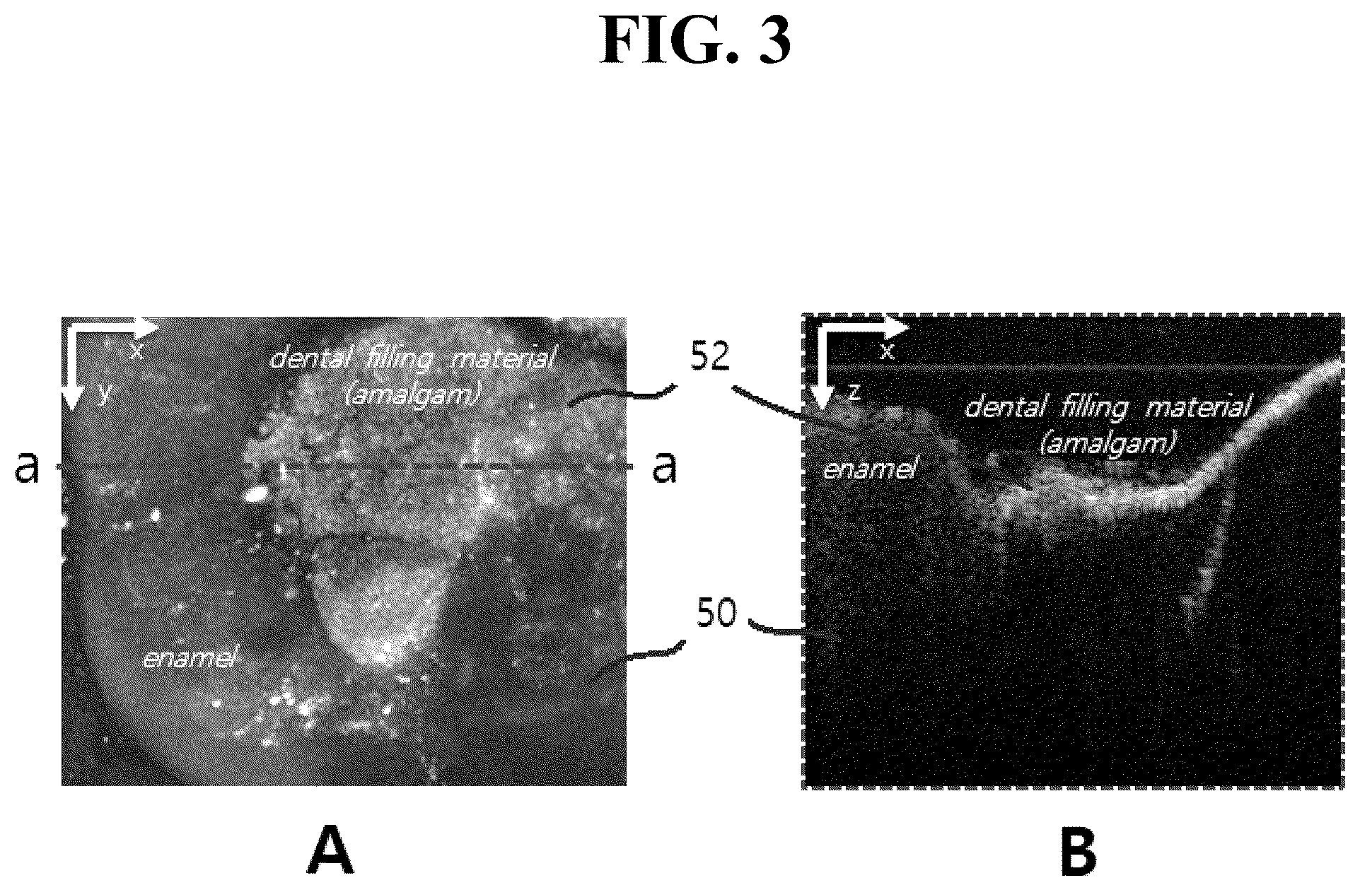 Patent US12324650 Figure 3 – Intraoral scanner having tomographic imaging function and method for detecting cracks in oral structures using the same