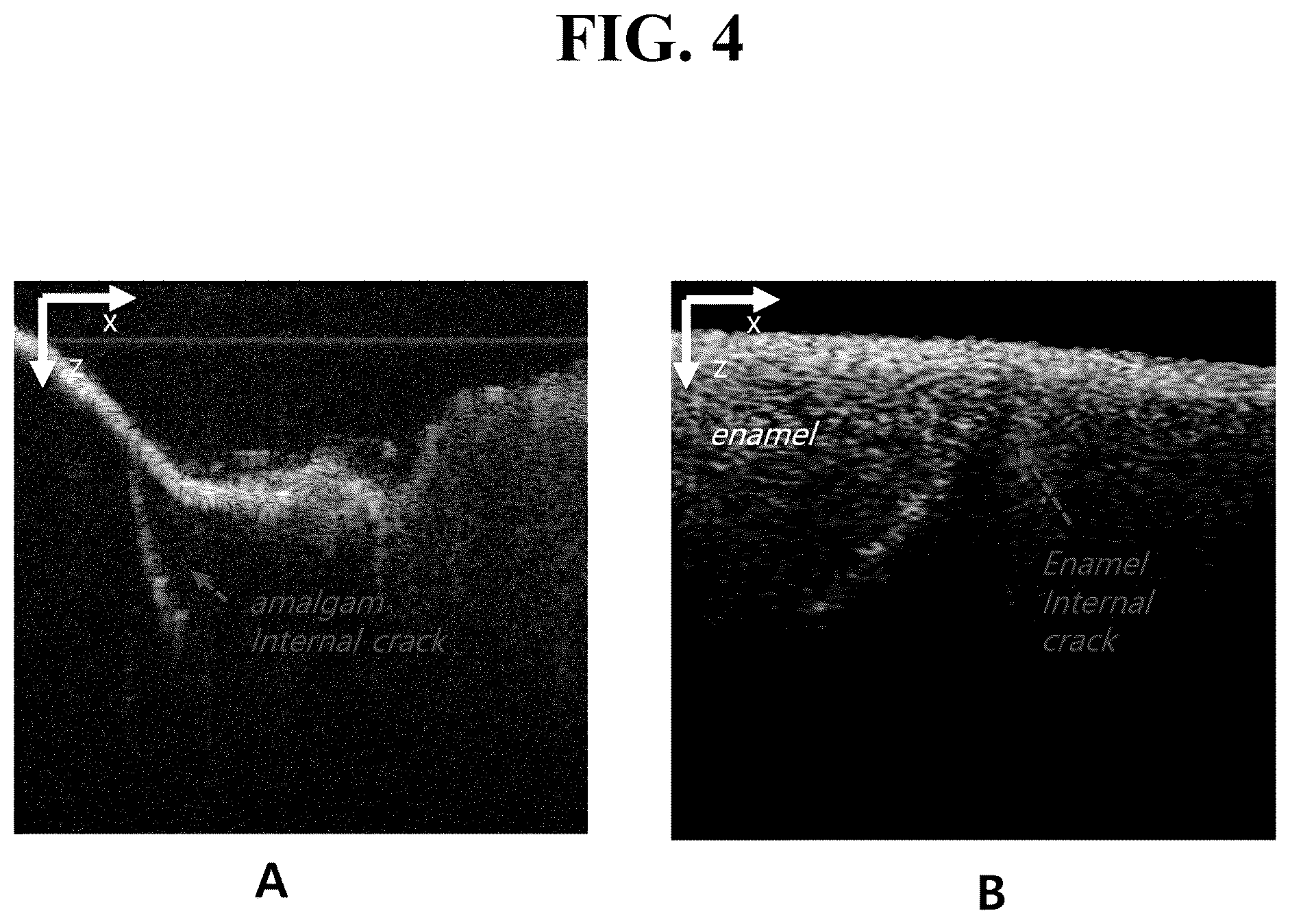 Patent US12324650 Figure 4 – Intraoral scanner having tomographic imaging function and method for detecting cracks in oral structures using the same