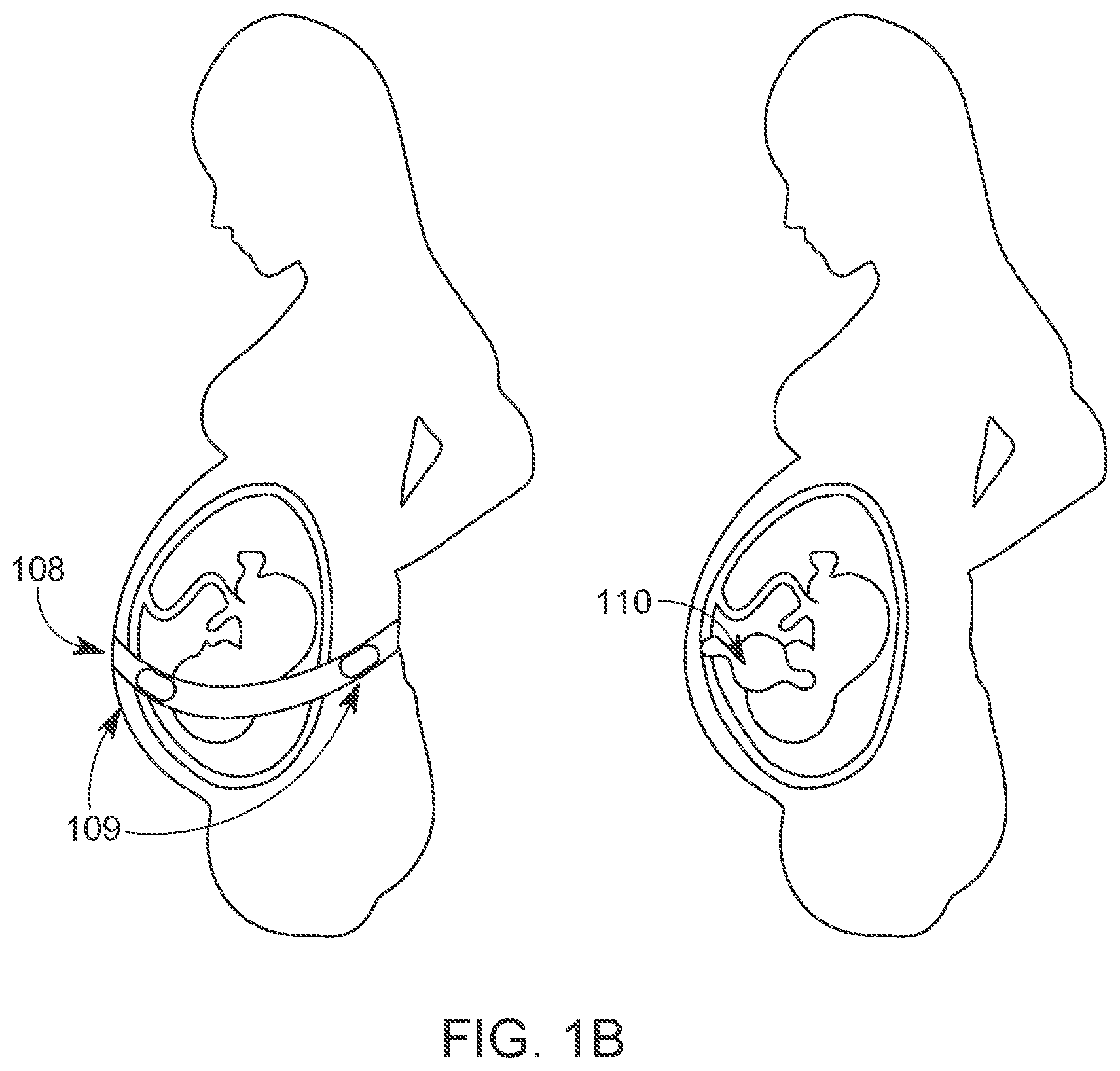 Patent US12324654 Figure 2 – Fetal health monitoring system and method for using the same