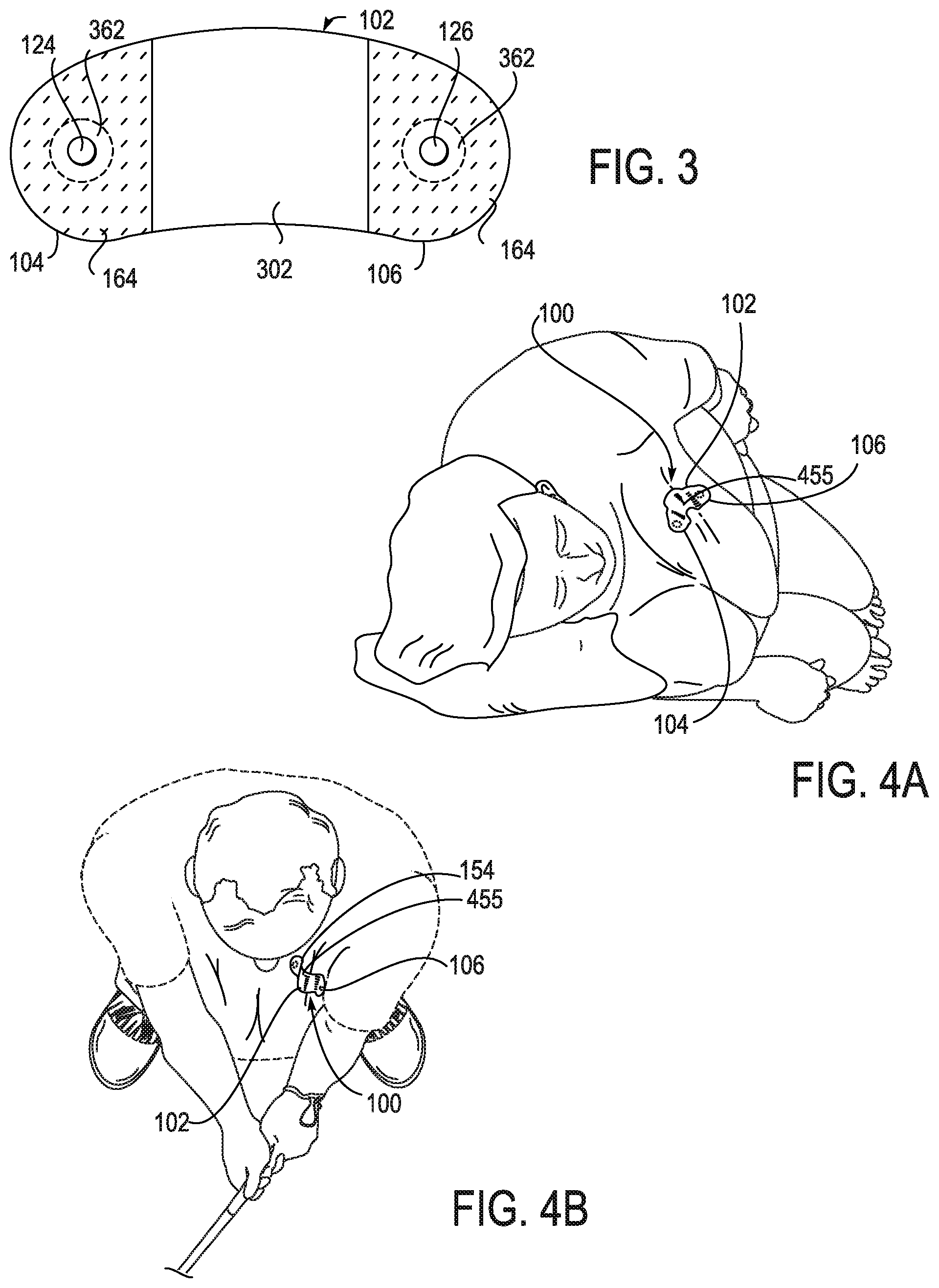 Patent US12324668 Figure 6 – Device features and design elements for long-term adhesion
