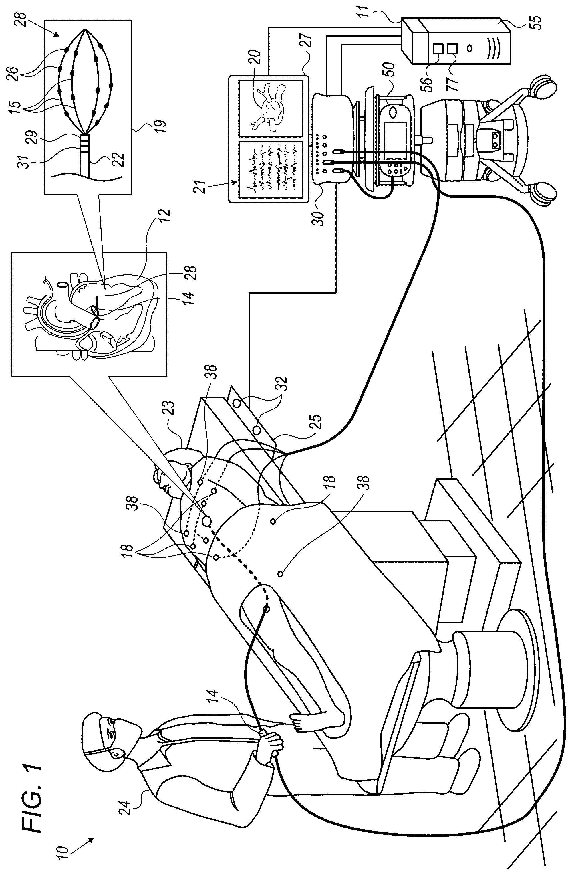 Patent US12324669 Figure 1 – Detecting local activation source in atrial fibrillation