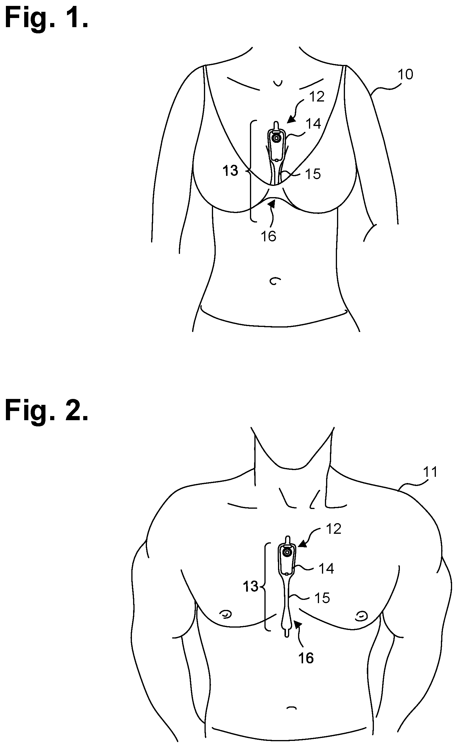 Patent US12324672 Figure 1 – Moisture-resistant electrocardiography monitor