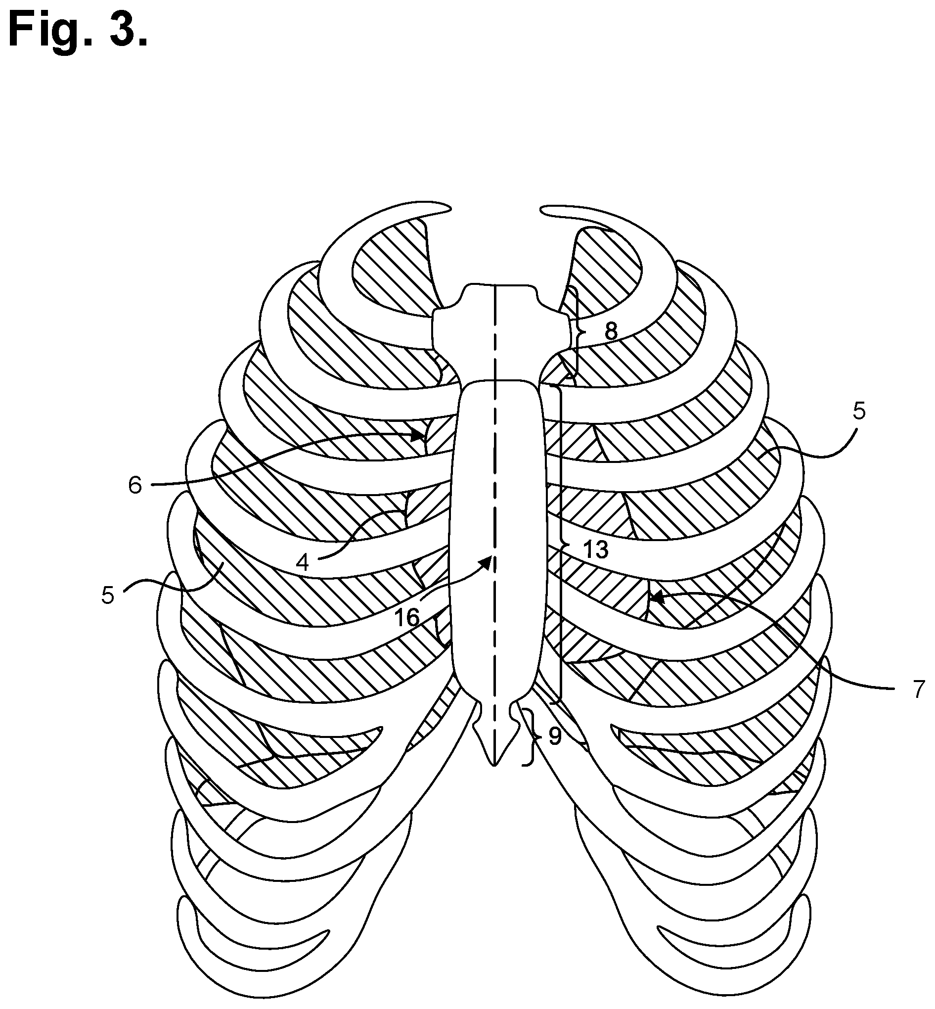 Patent US12324672 Figure 2 – Moisture-resistant electrocardiography monitor