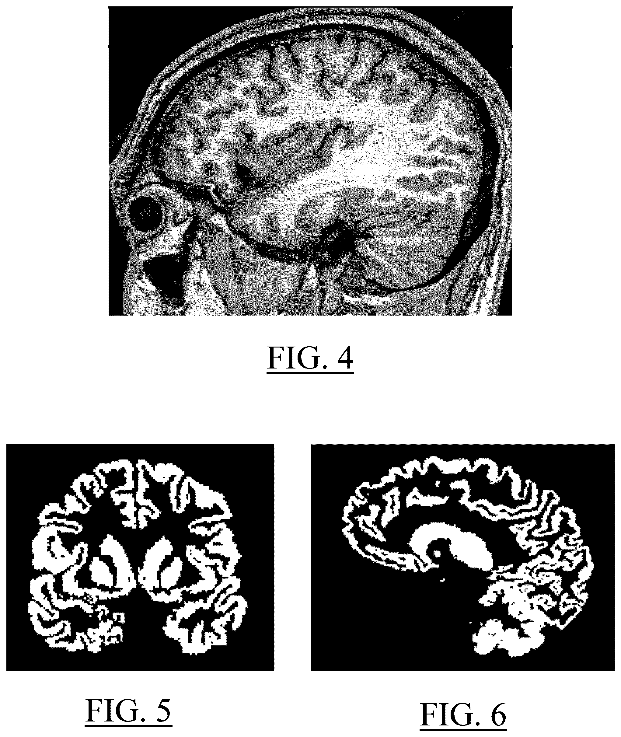 Patent US12324674 Figure 4 – Voxelization of a 3D structural medical image of a human's brain