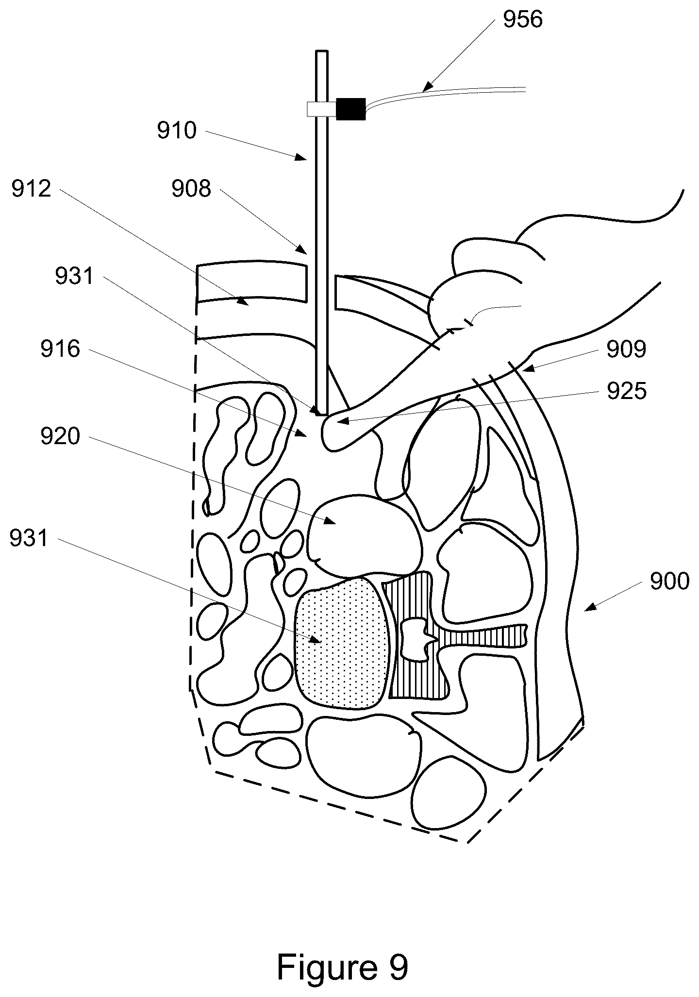 Patent US12324684 Figure 10 – Detecting and avoiding blood vessels