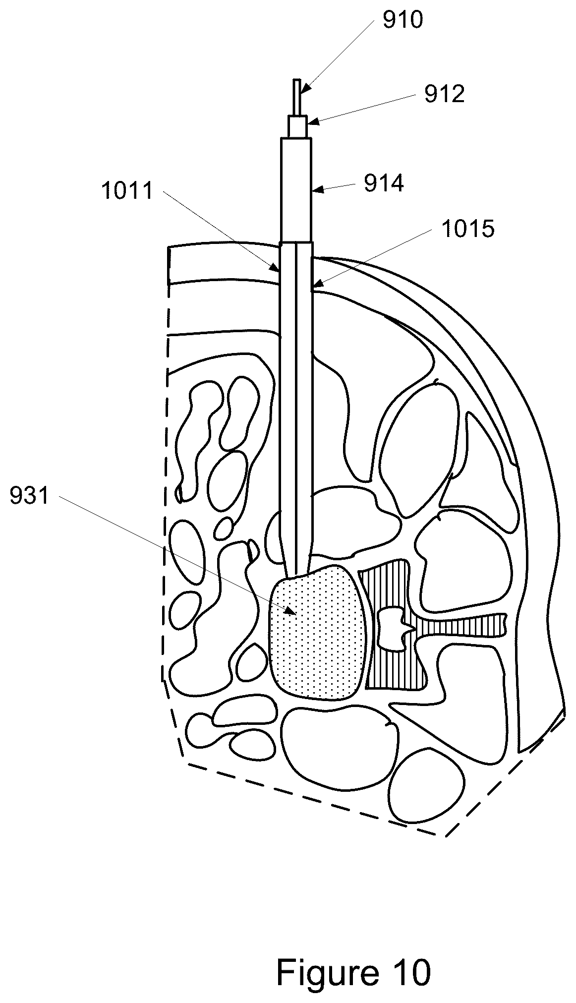 Patent US12324684 Figure 11 – Detecting and avoiding blood vessels