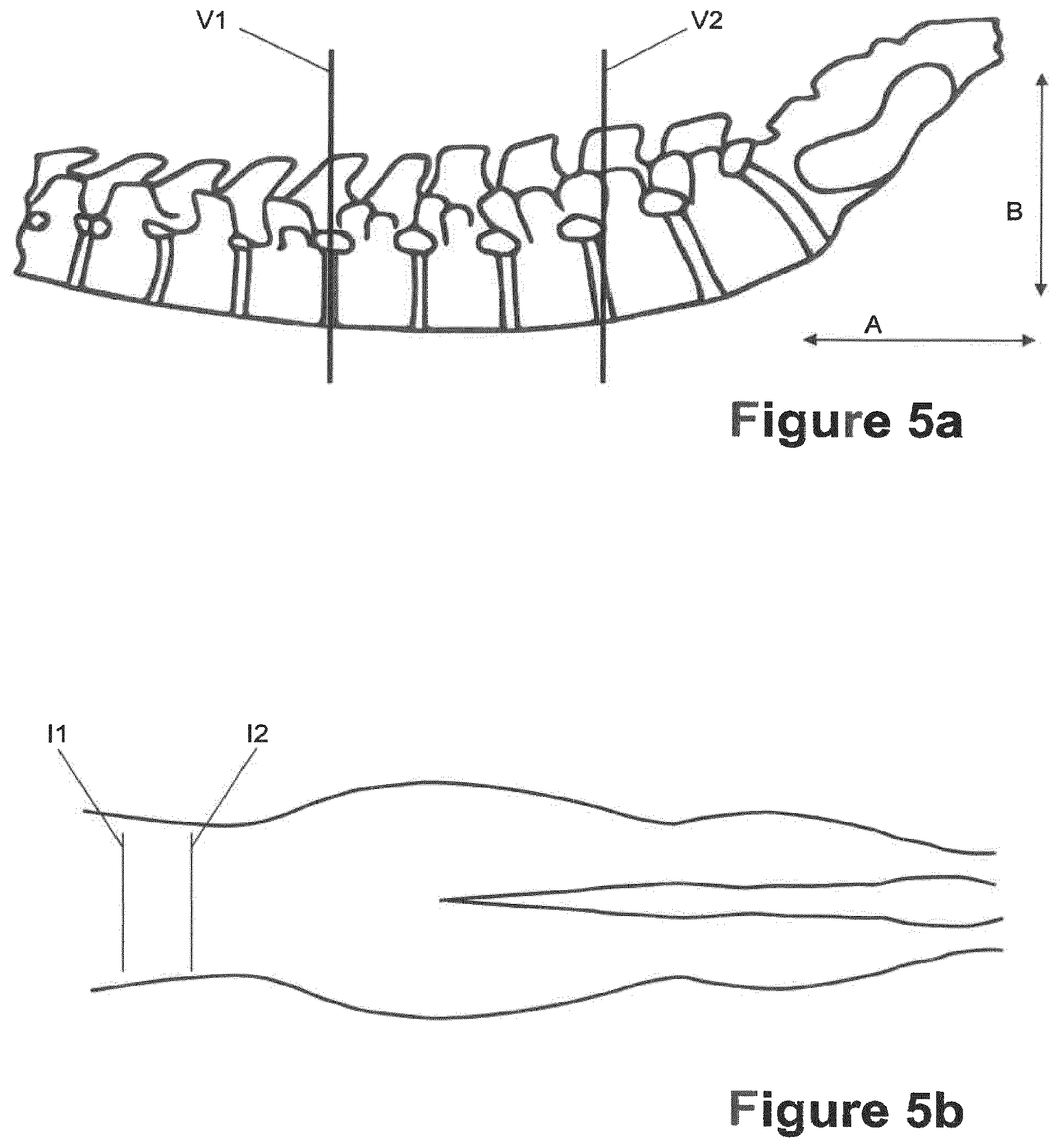 Patent US12324693 Figure 3 – Method and system for projecting an incision marker onto a patient