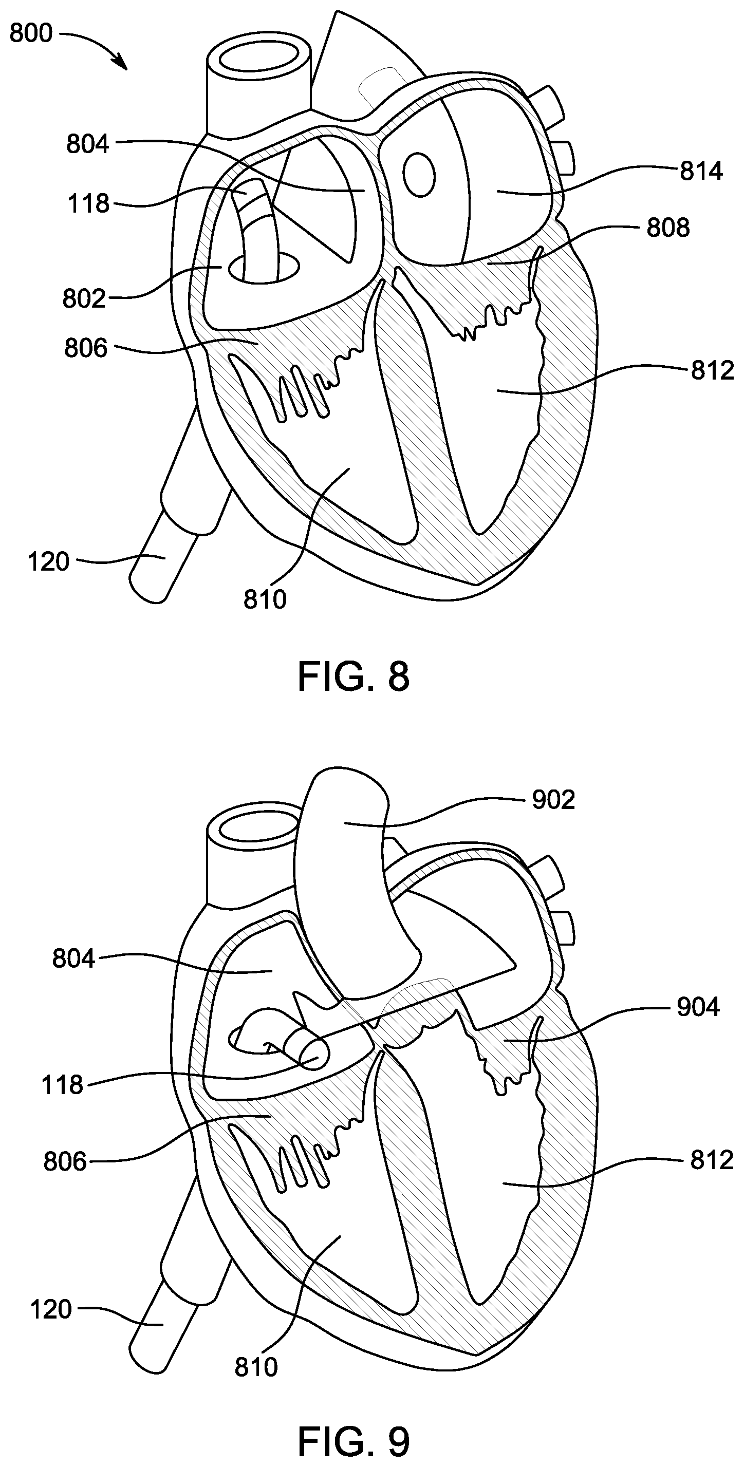 Patent US12324702 Figure 7 – Ultrasonic catheter