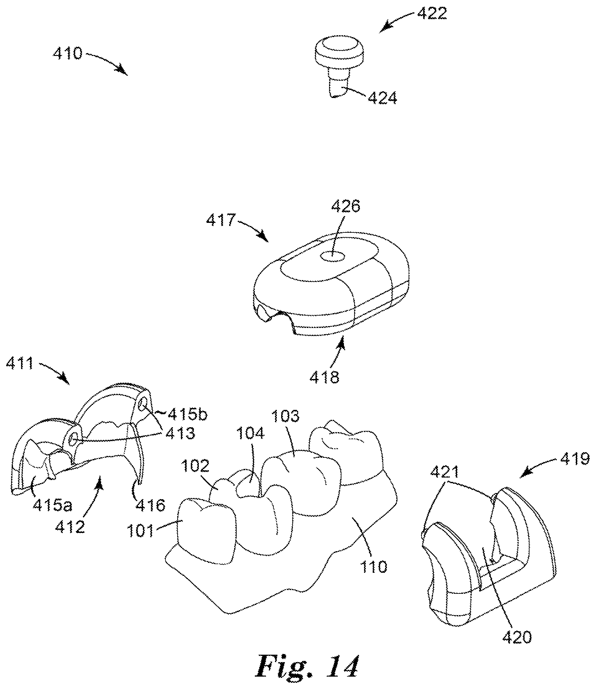 Patent US12324715 Figure 13 – Dental restoration molds