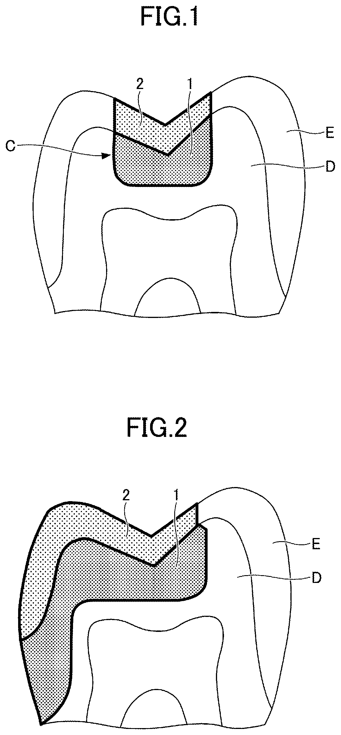 Patent US12324717 Figure 1 – Dental restorative set and method of restoring tooth