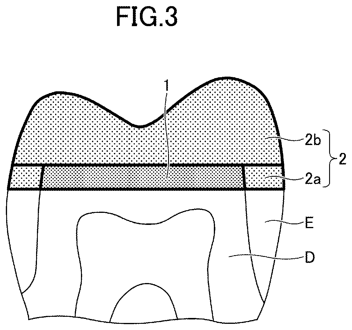 Patent US12324717 Figure 2 – Dental restorative set and method of restoring tooth