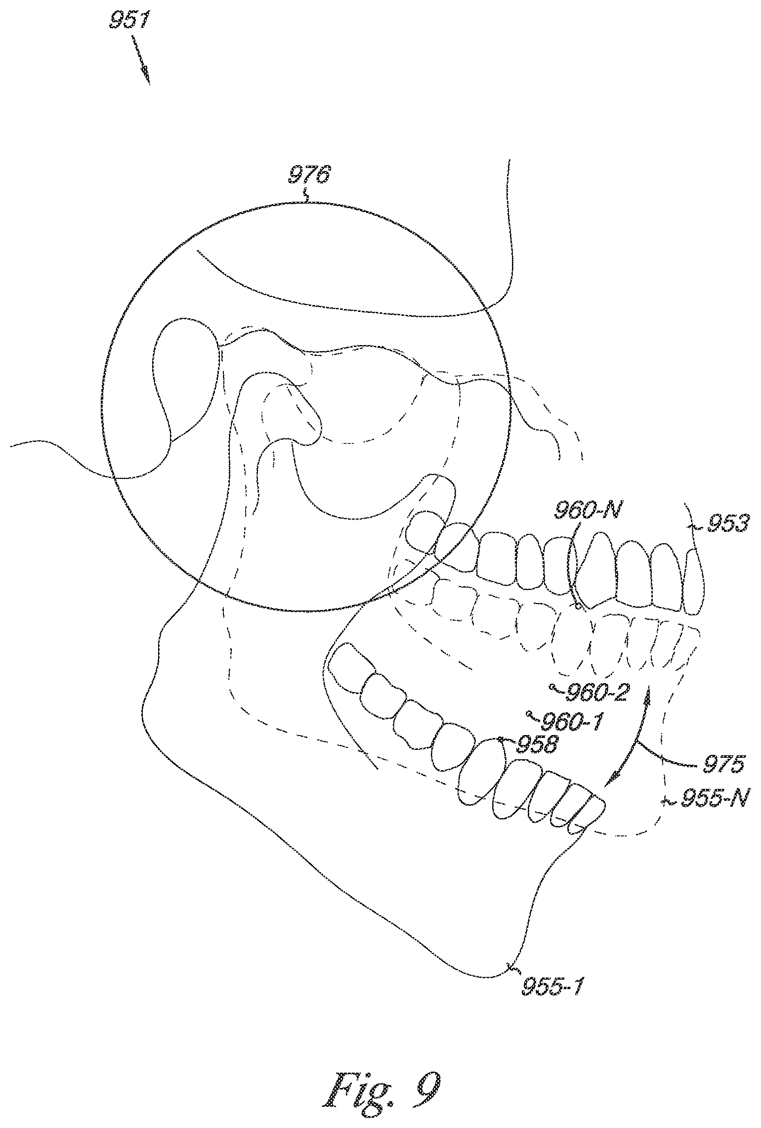 Patent US12324720 Figure 10 – Bite setting for dental treatment planning