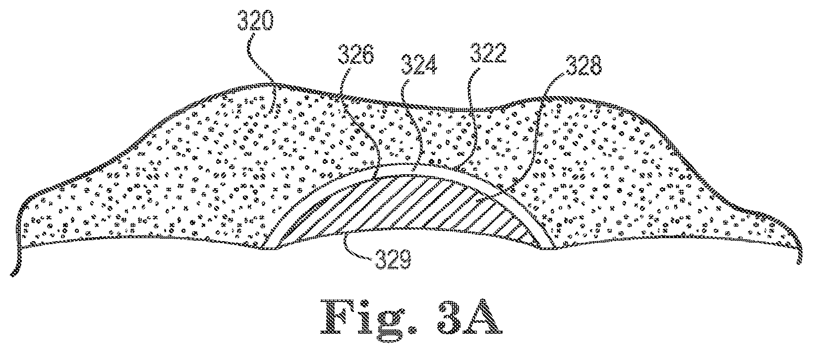 Patent US12324721 Figure 2 – Dental attachment positioning apparatuses