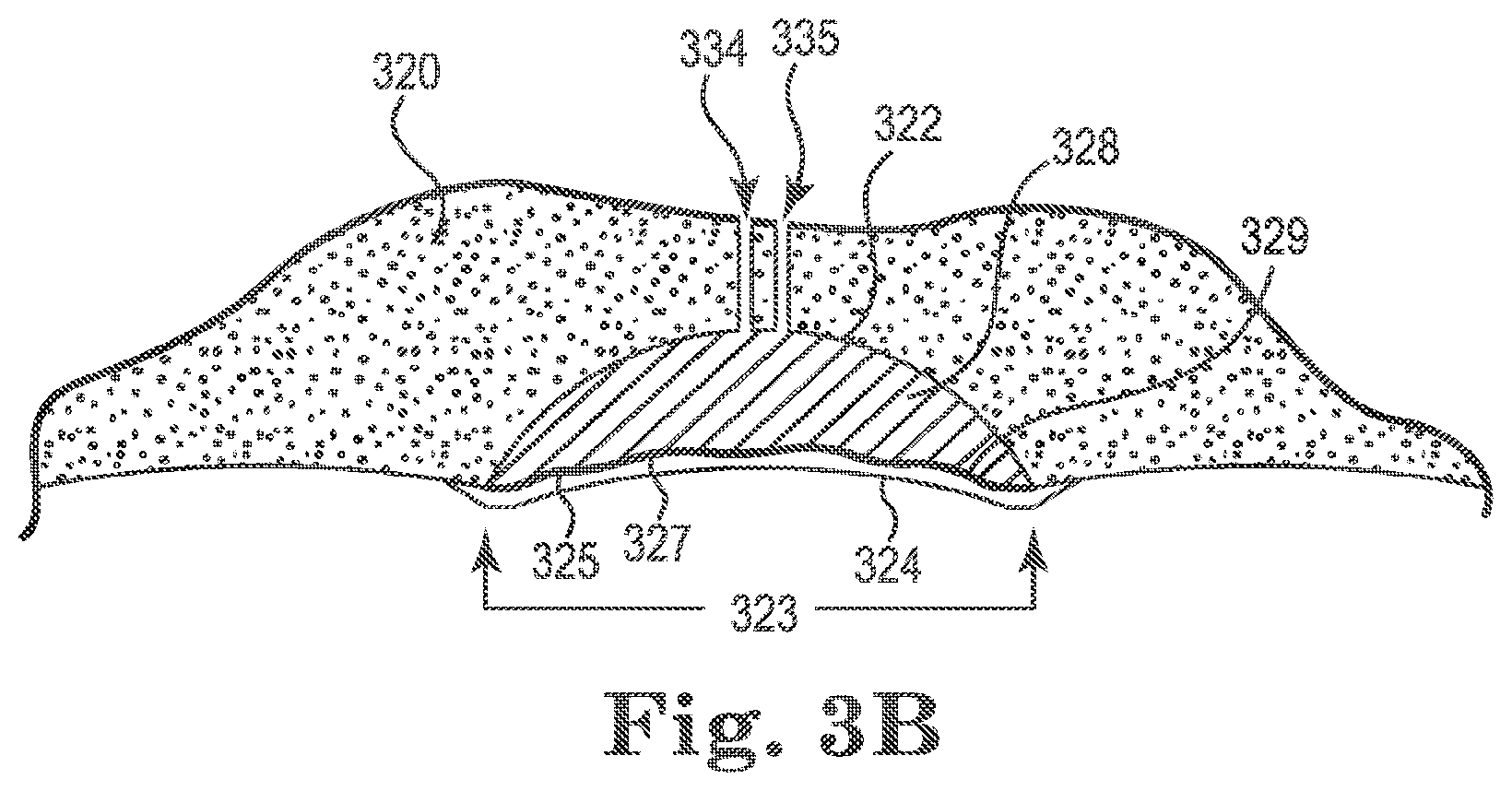 Patent US12324721 Figure 3 – Dental attachment positioning apparatuses