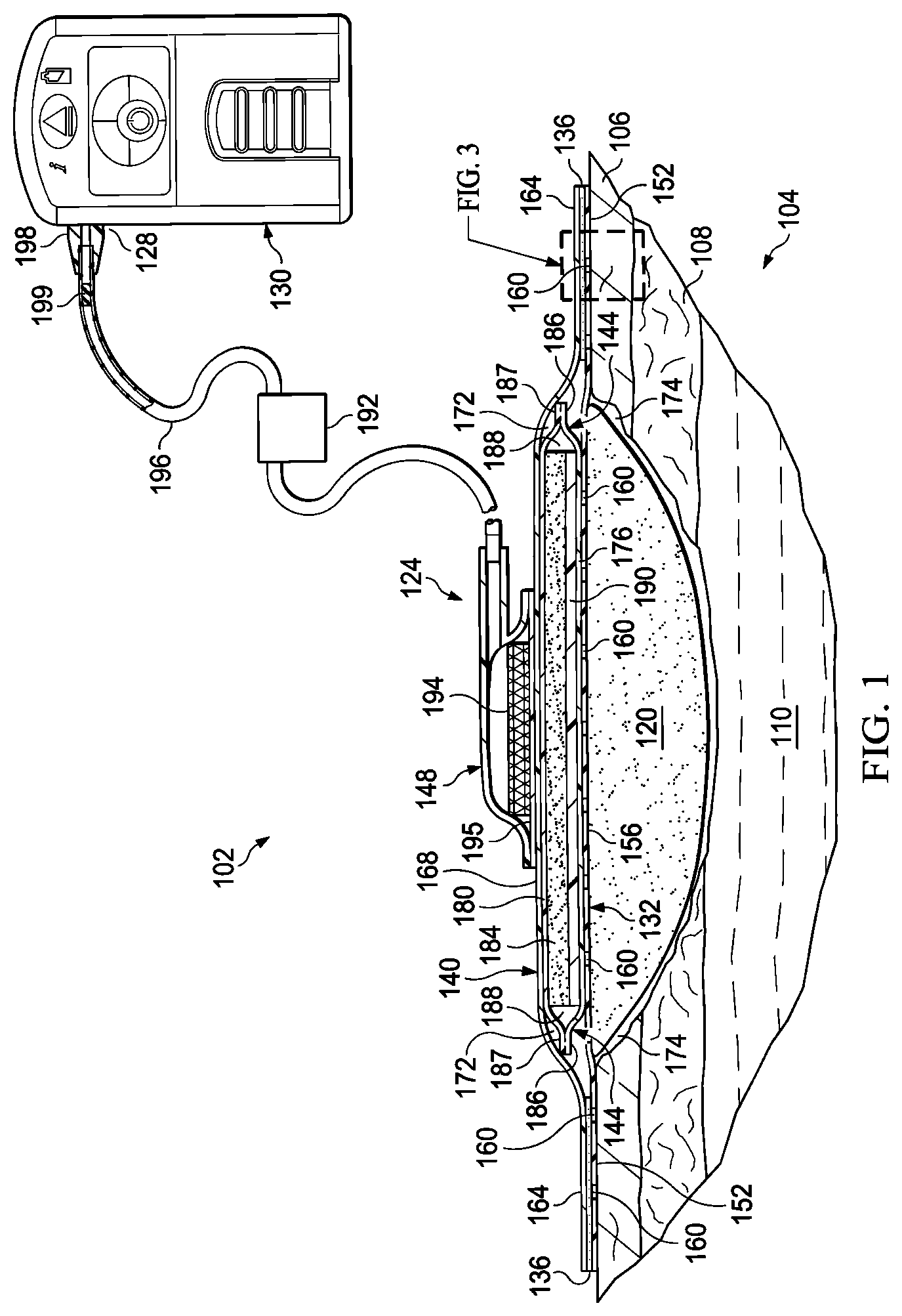 Patent US12324725 Figure 1 – Dressing with sealing and retention interface