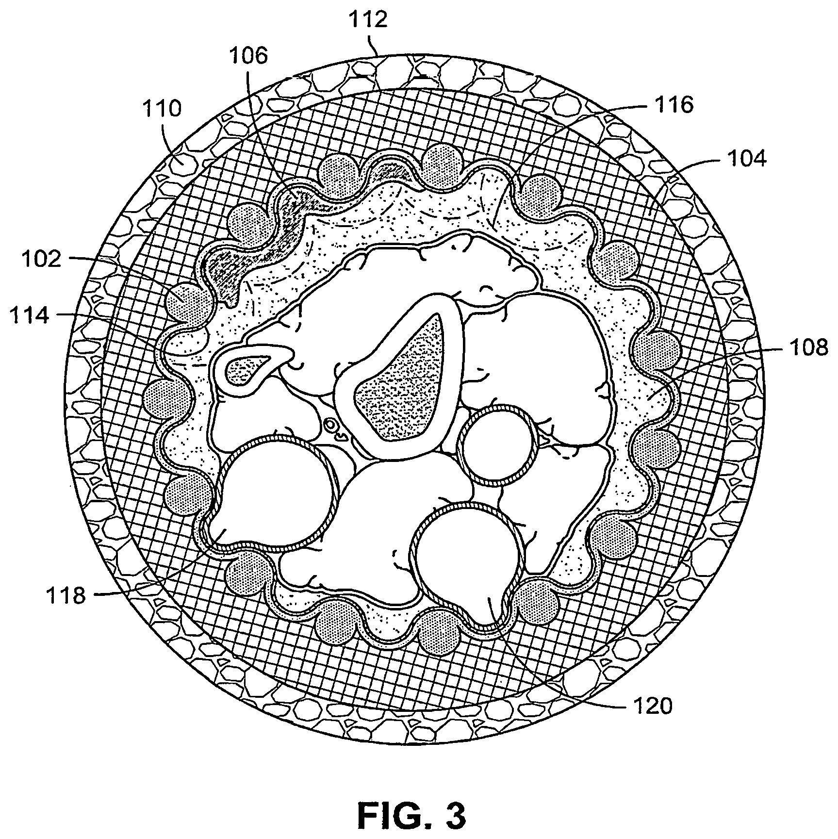 Patent US12324726 Figure 4 – Wound dressing garments, kits, systems, and methods