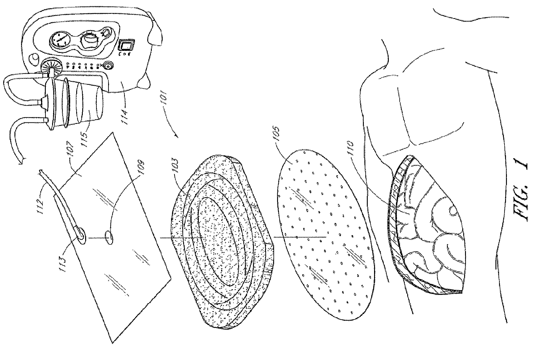 Patent US12324727 Figure 1 – Wound treatment apparatuses