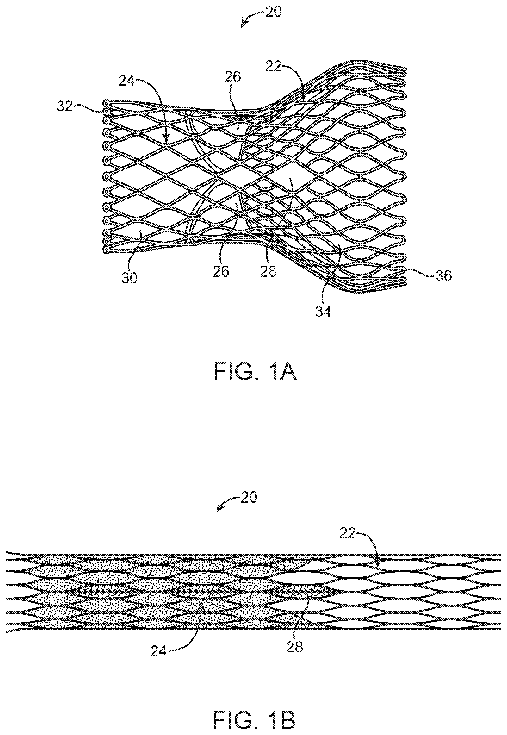 Patent US12324736 Figure 1 – Stented prosthetic heart valve with variable stiffness and methods of use