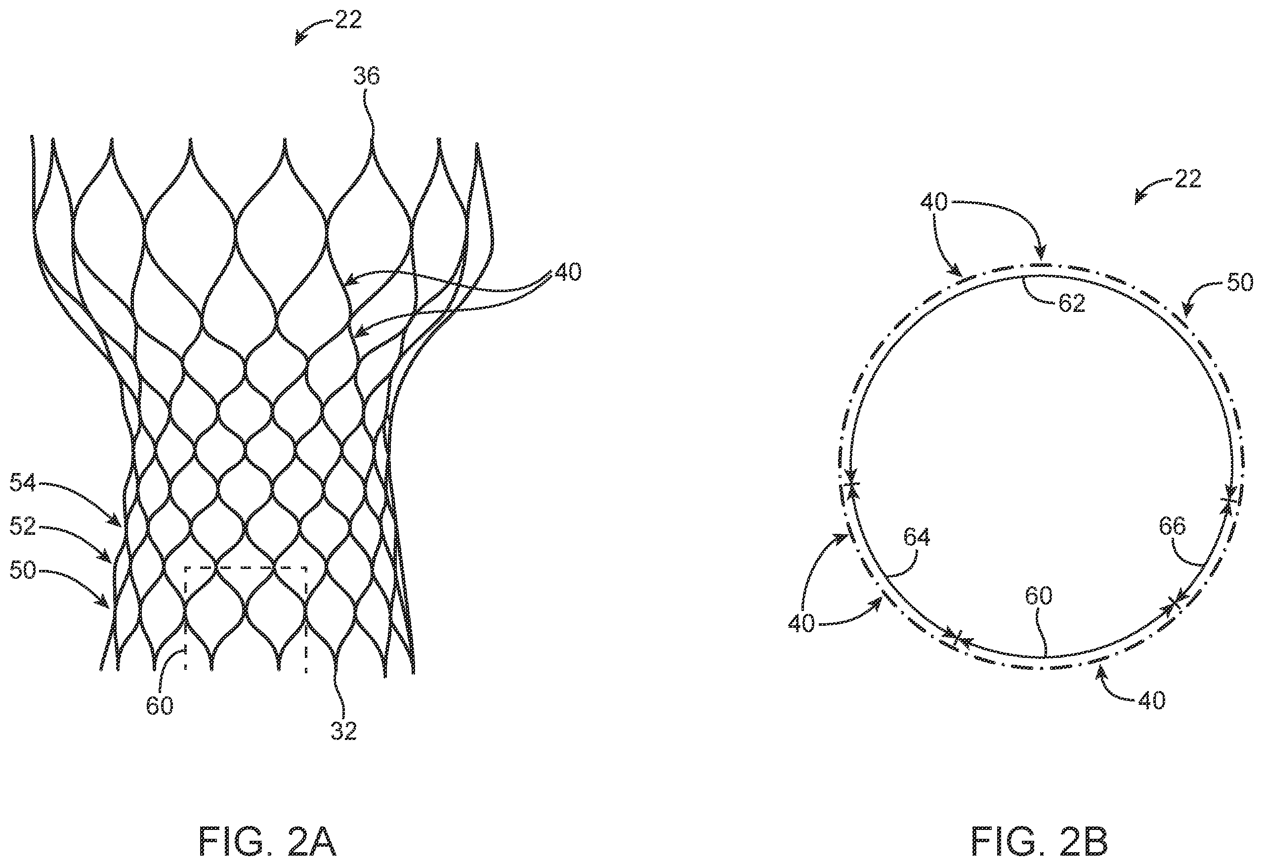 Patent US12324736 Figure 2 – Stented prosthetic heart valve with variable stiffness and methods of use