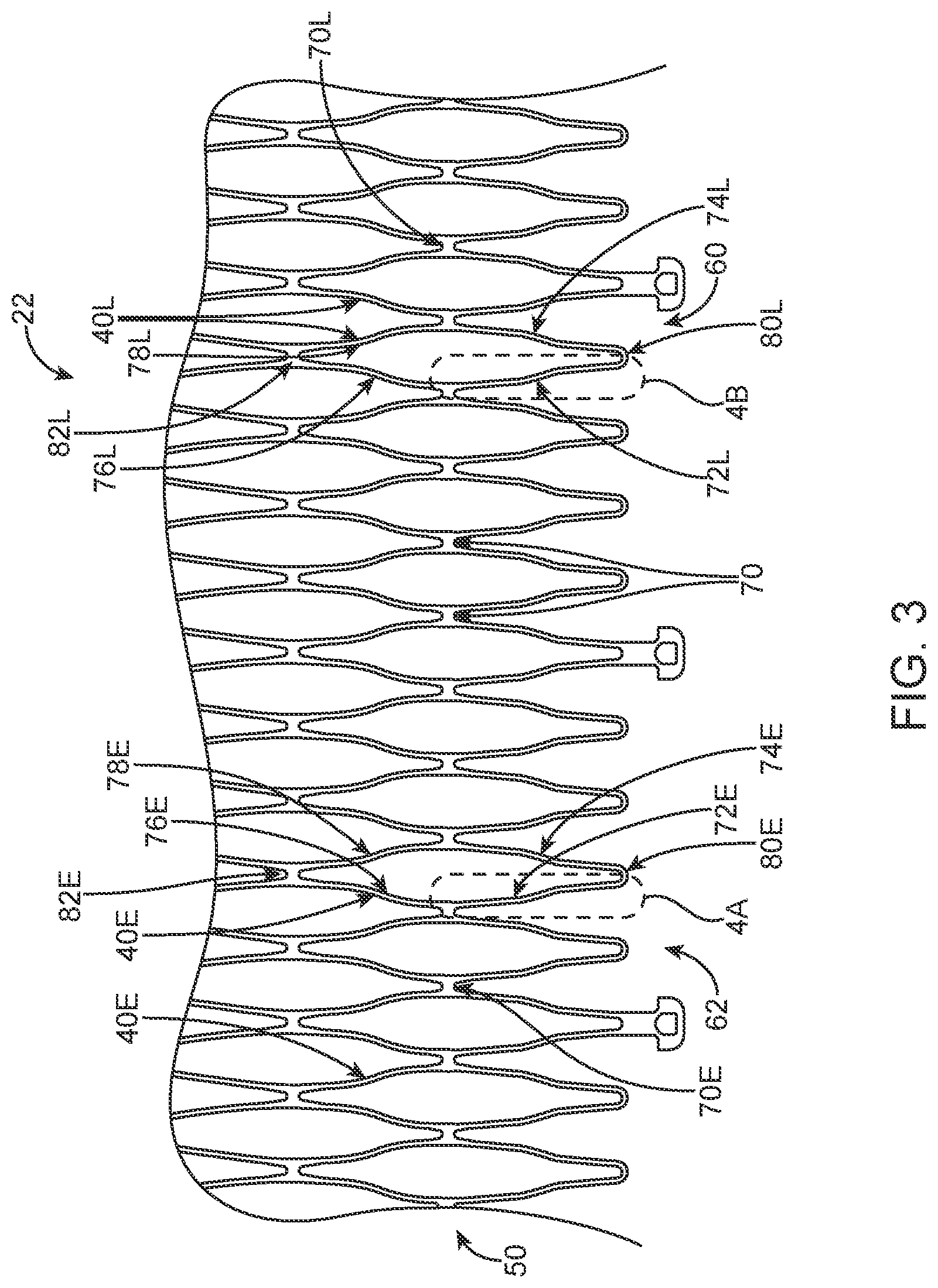 Patent US12324736 Figure 3 – Stented prosthetic heart valve with variable stiffness and methods of use