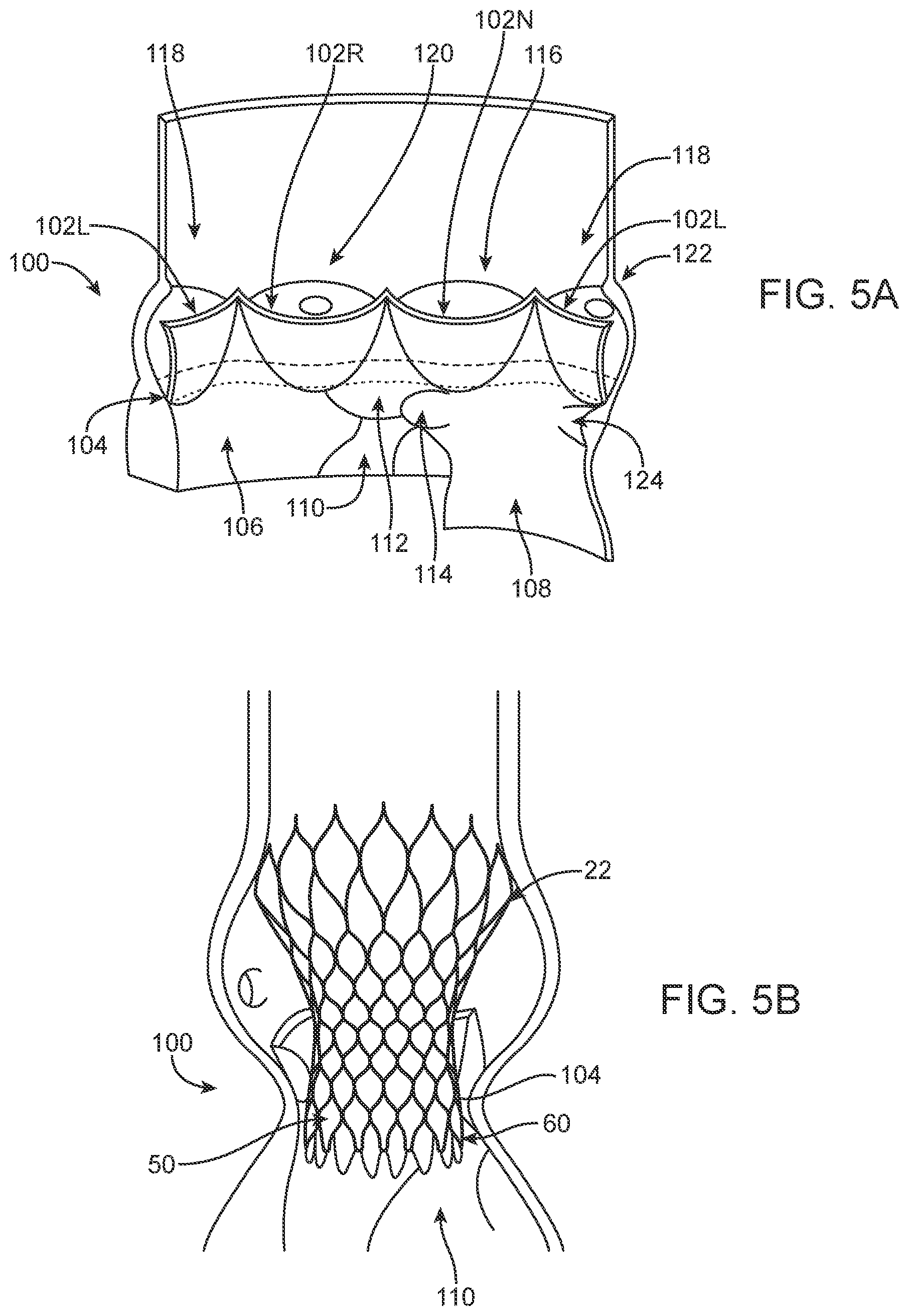 Patent US12324736 Figure 6 – Stented prosthetic heart valve with variable stiffness and methods of use