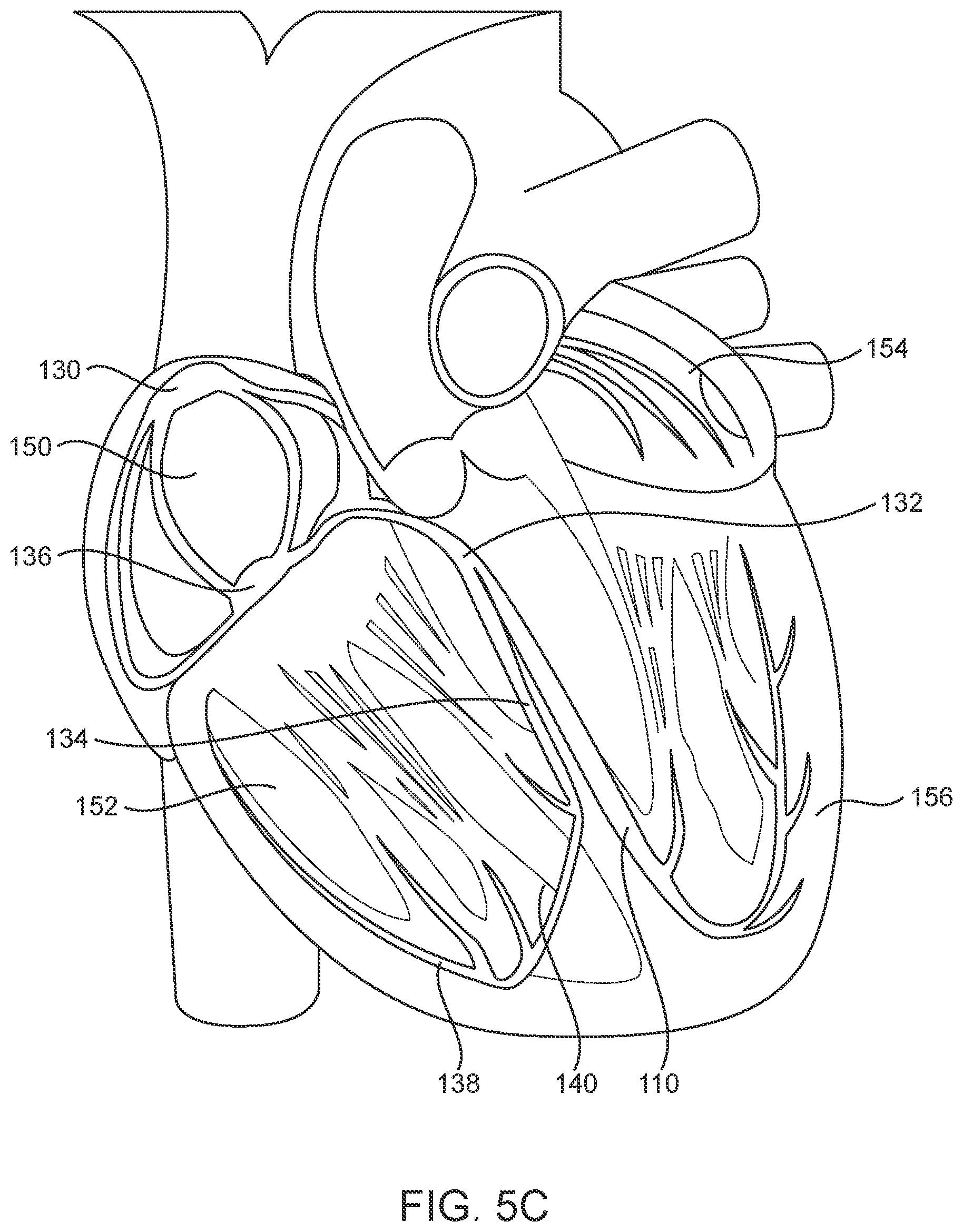 Patent US12324736 Figure 7 – Stented prosthetic heart valve with variable stiffness and methods of use