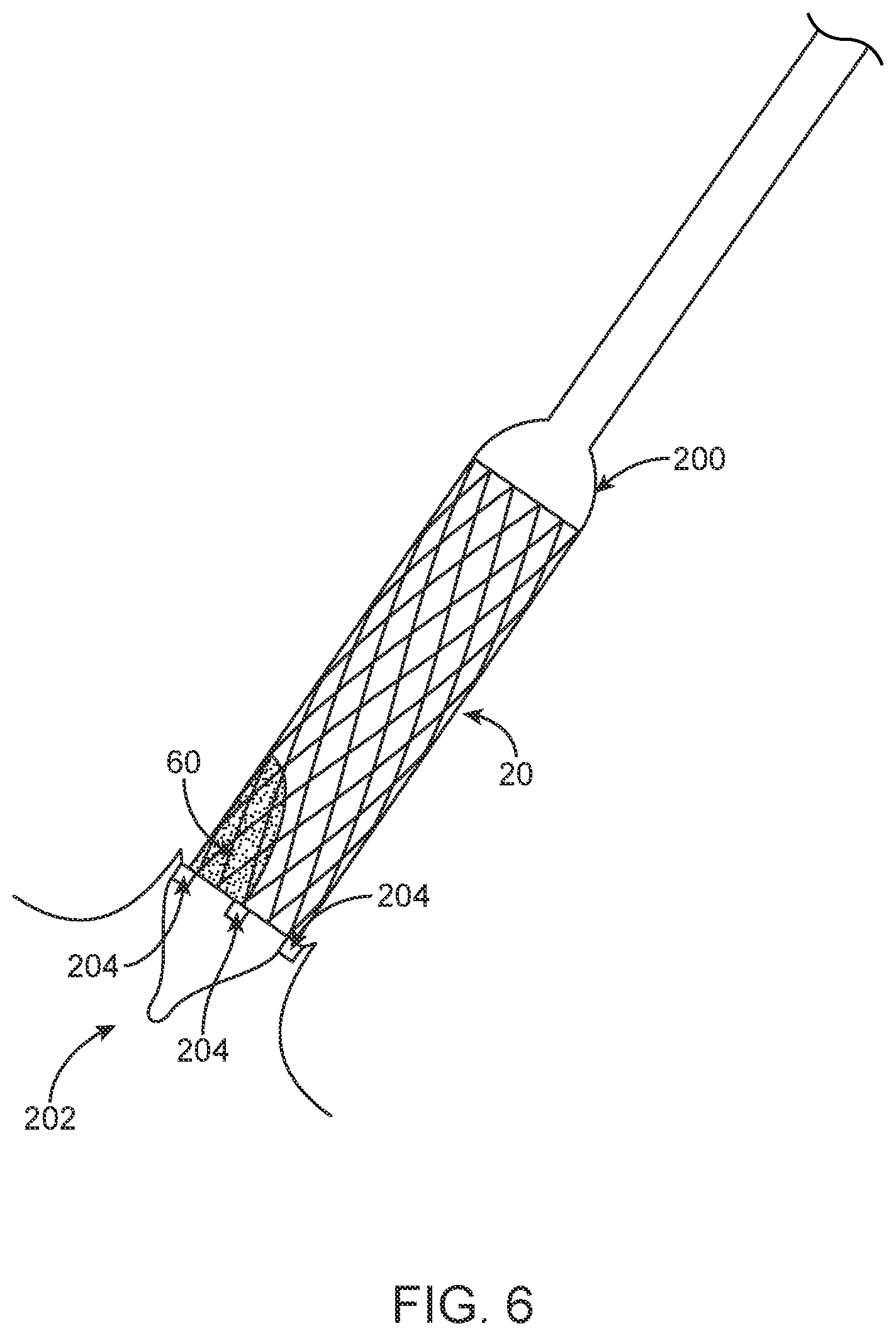 Patent US12324736 Figure 8 – Stented prosthetic heart valve with variable stiffness and methods of use