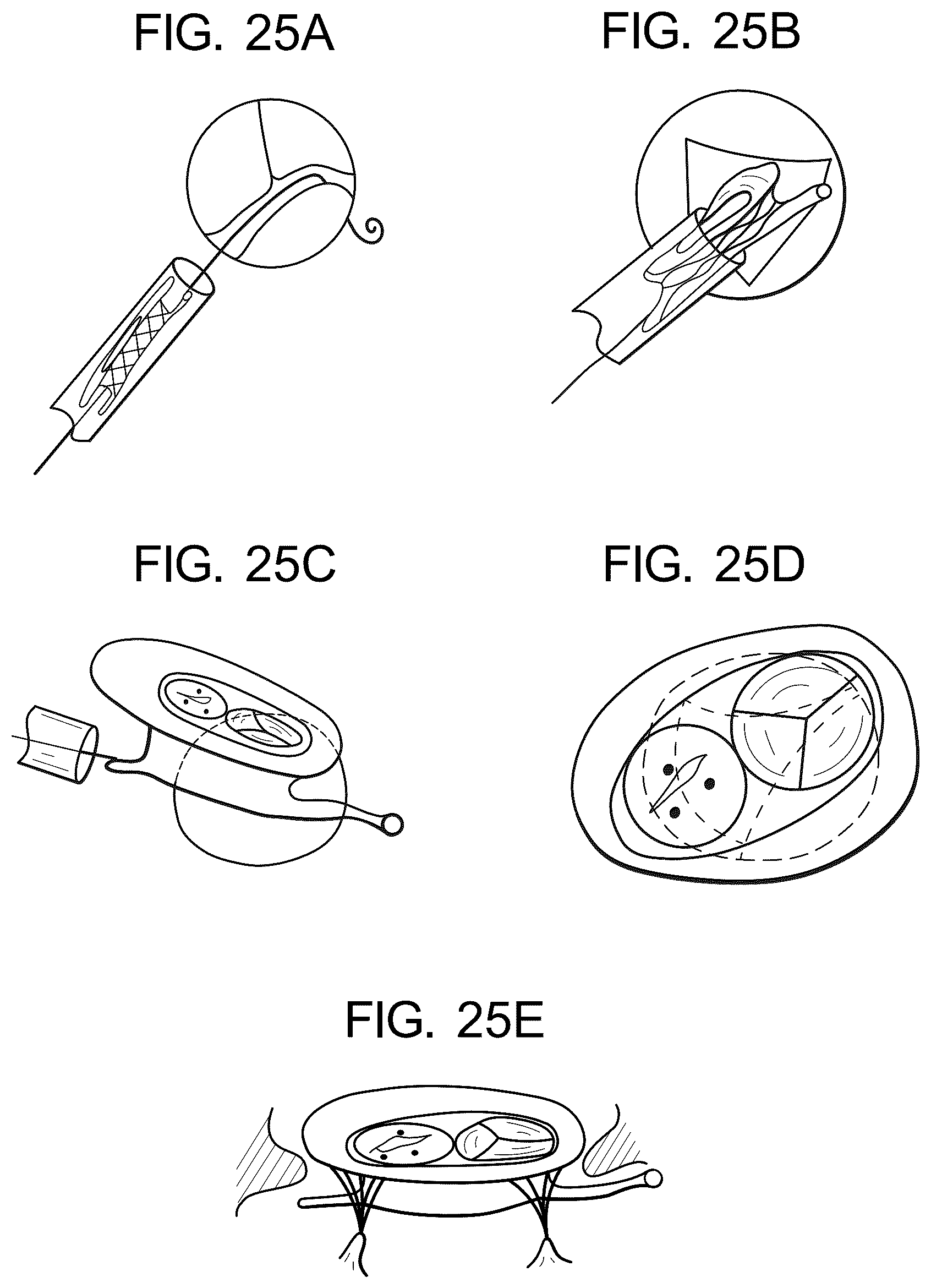Patent US12324737 Figure 11 – Tricuspid regurgitation control devices for orthogonal transcatheter heart valve prosthesis