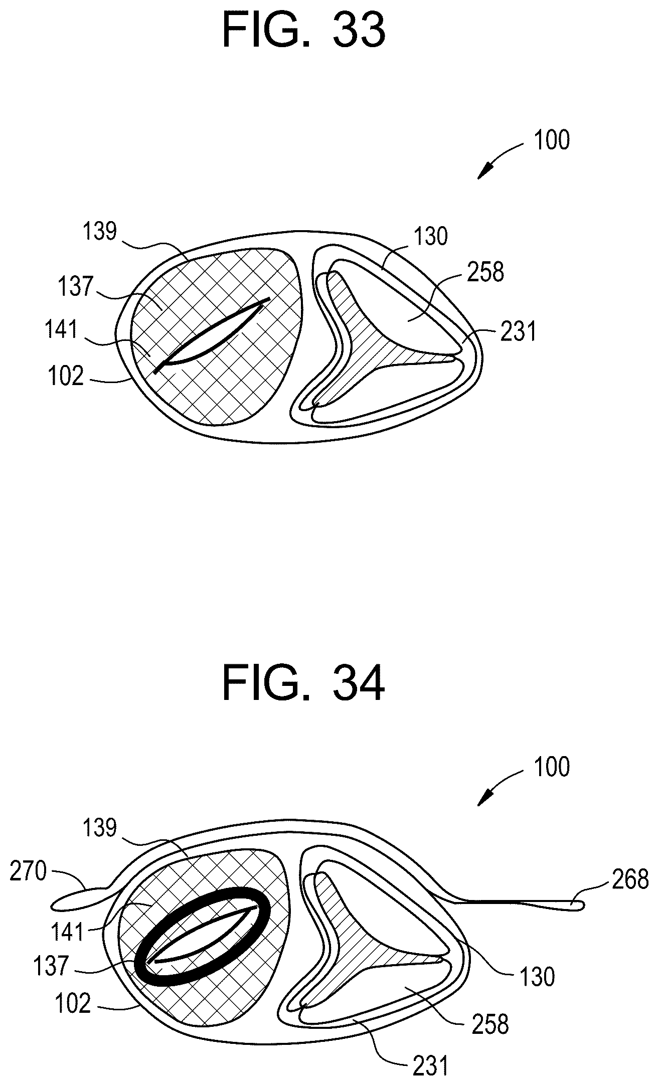 Patent US12324737 Figure 15 – Tricuspid regurgitation control devices for orthogonal transcatheter heart valve prosthesis