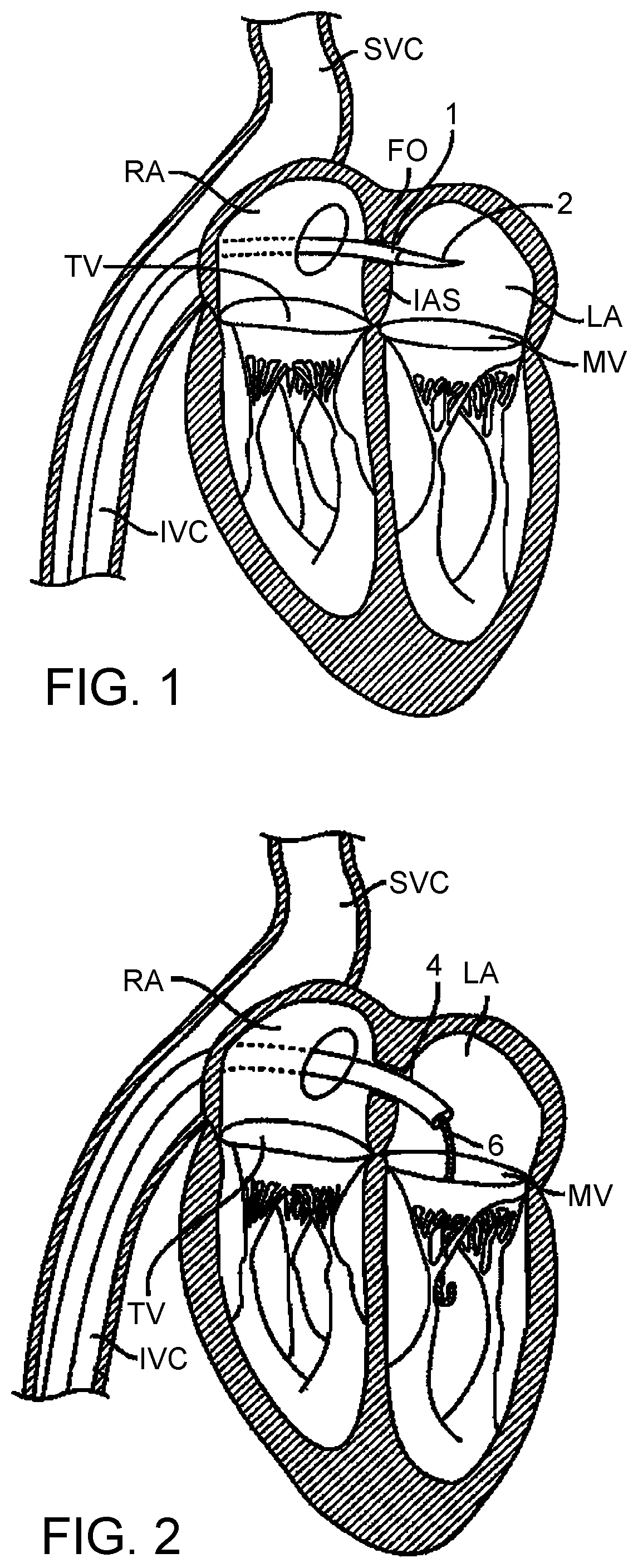Patent US12324738 Figure 1 – Hydraulic delivery systems with flow diversion devices and associated methods
