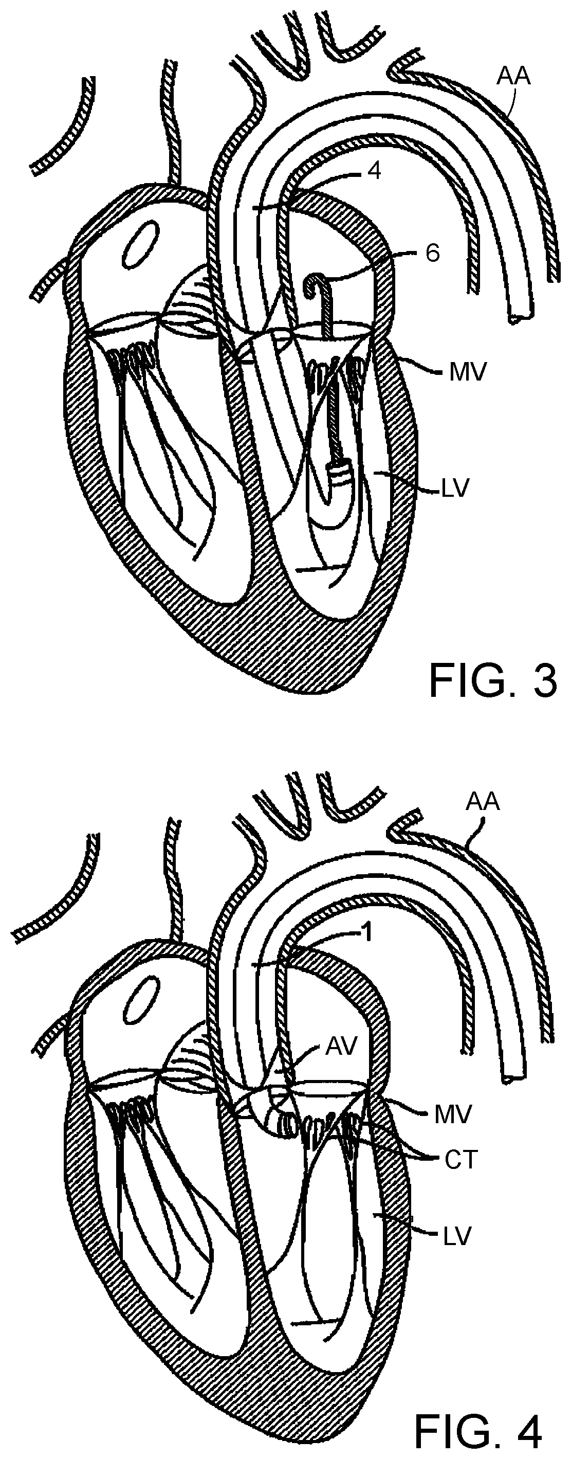 Patent US12324738 Figure 2 – Hydraulic delivery systems with flow diversion devices and associated methods