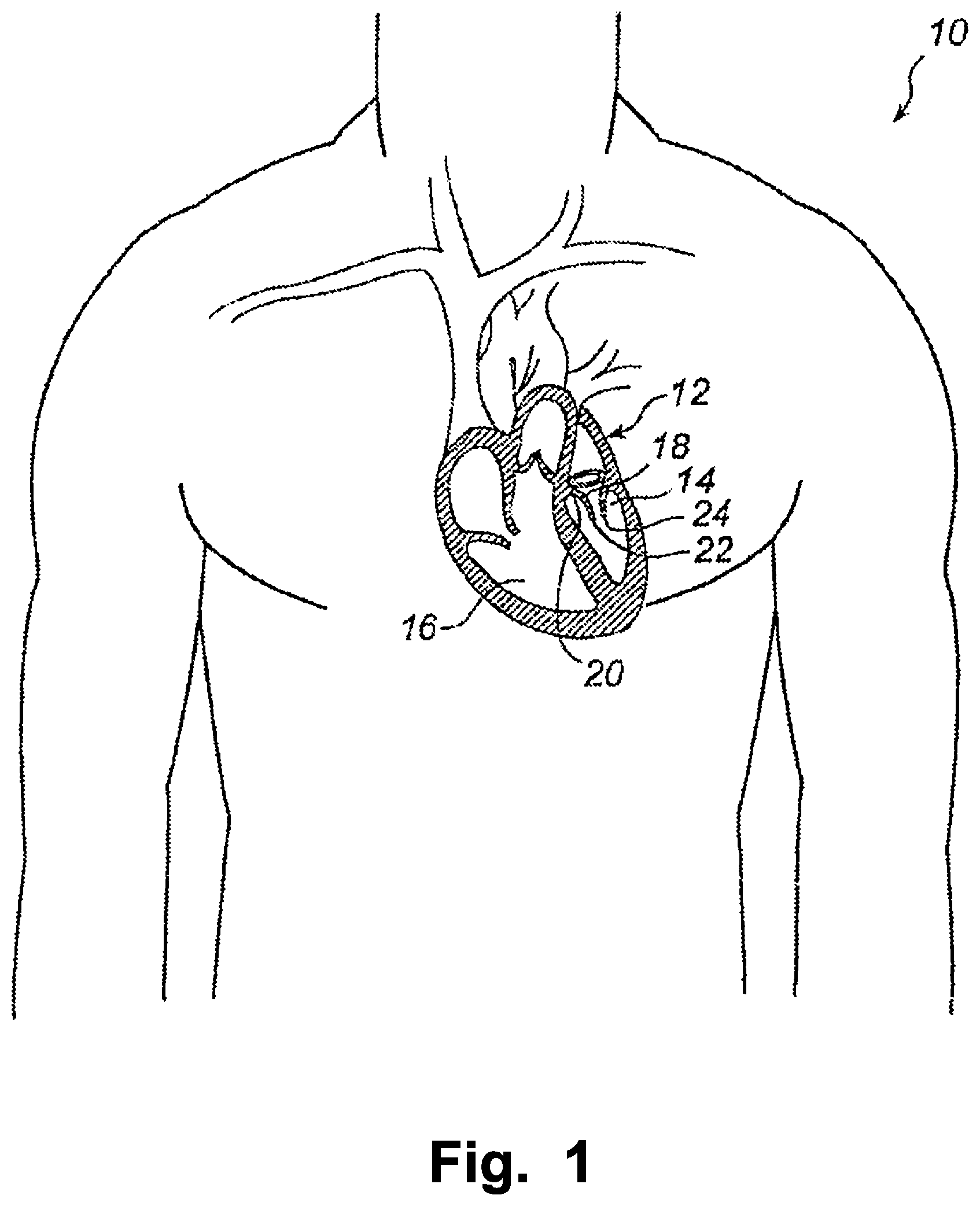 Patent US12324740 Figure 1 – Device and method for improving function of heart valve