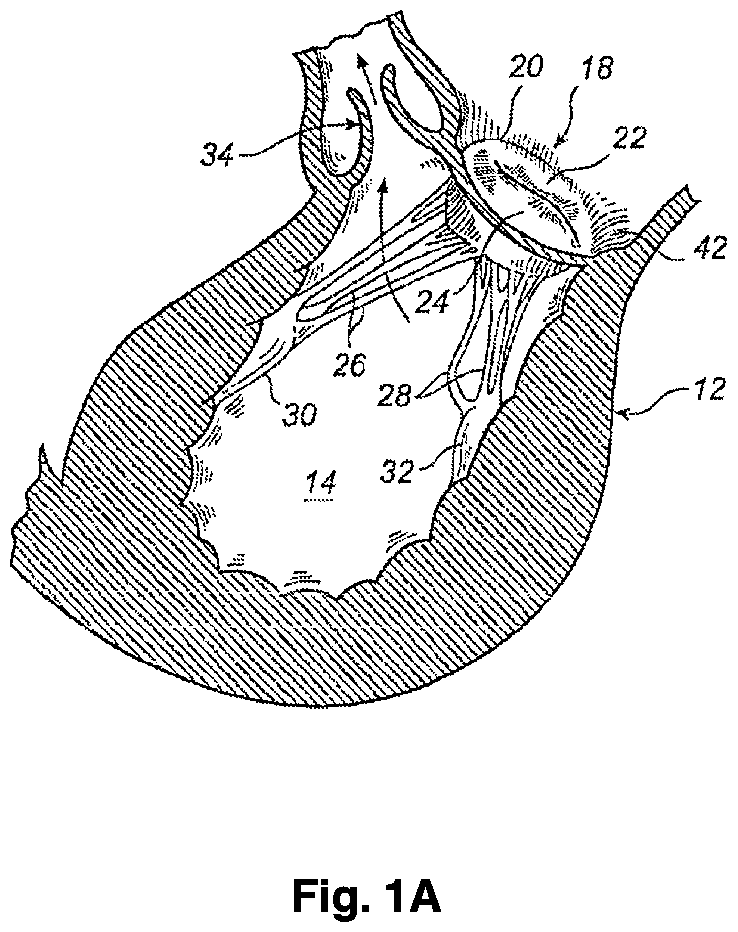 Patent US12324740 Figure 2 – Device and method for improving function of heart valve