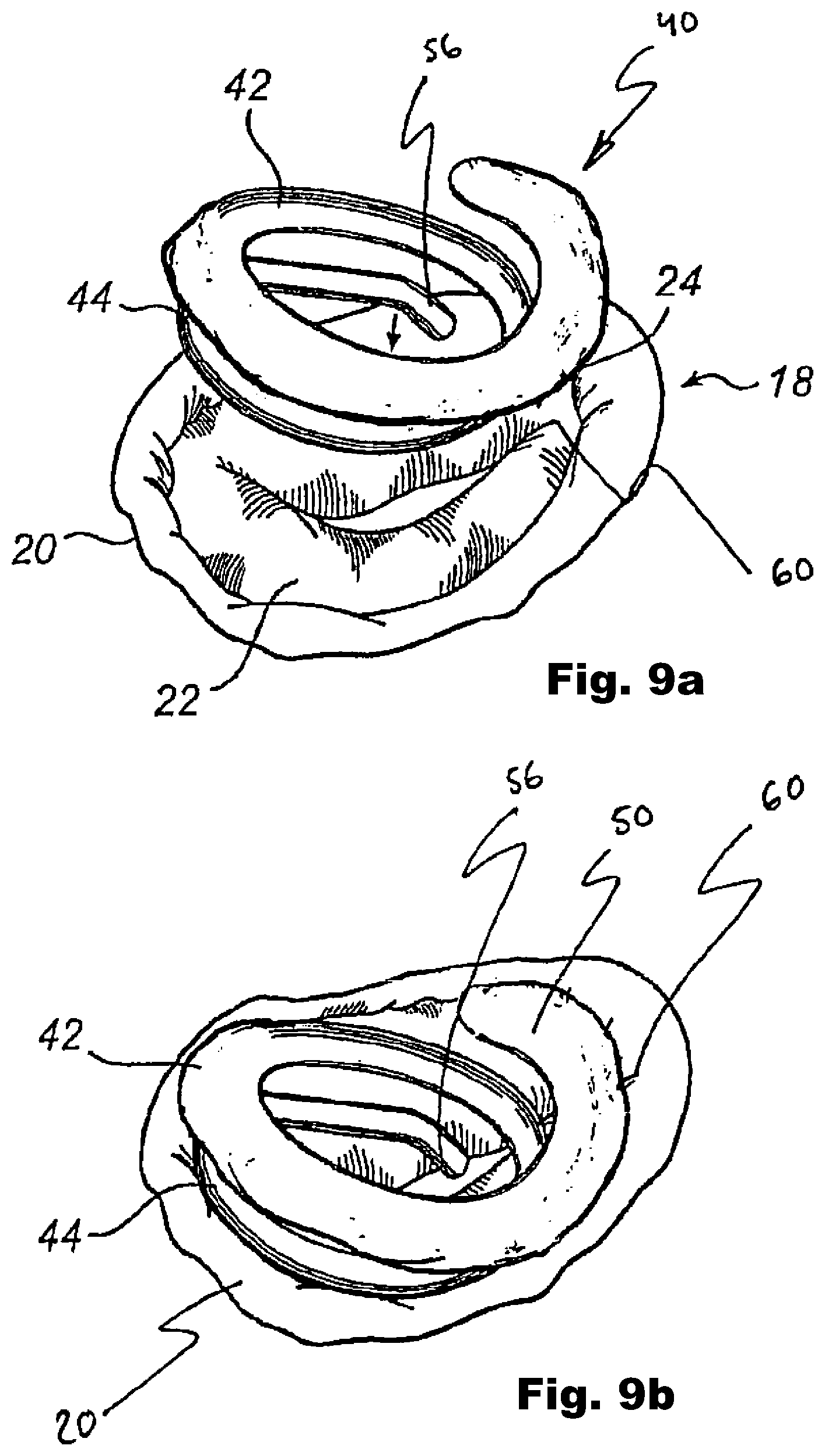 Patent US12324740 Figure 6 – Device and method for improving function of heart valve