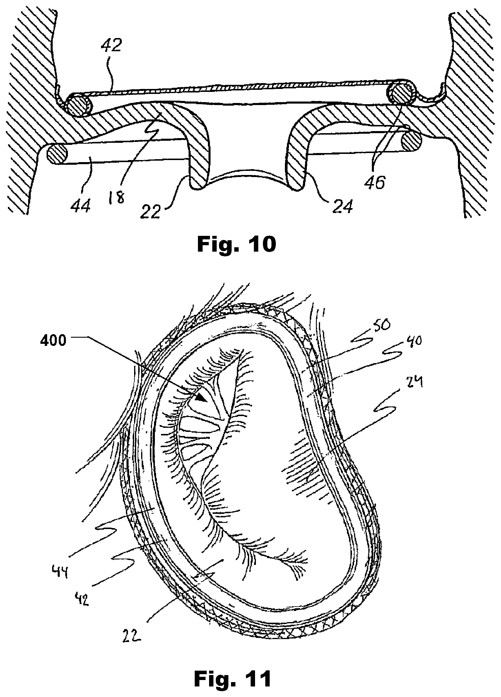 Patent US12324740 Figure 7 – Device and method for improving function of heart valve