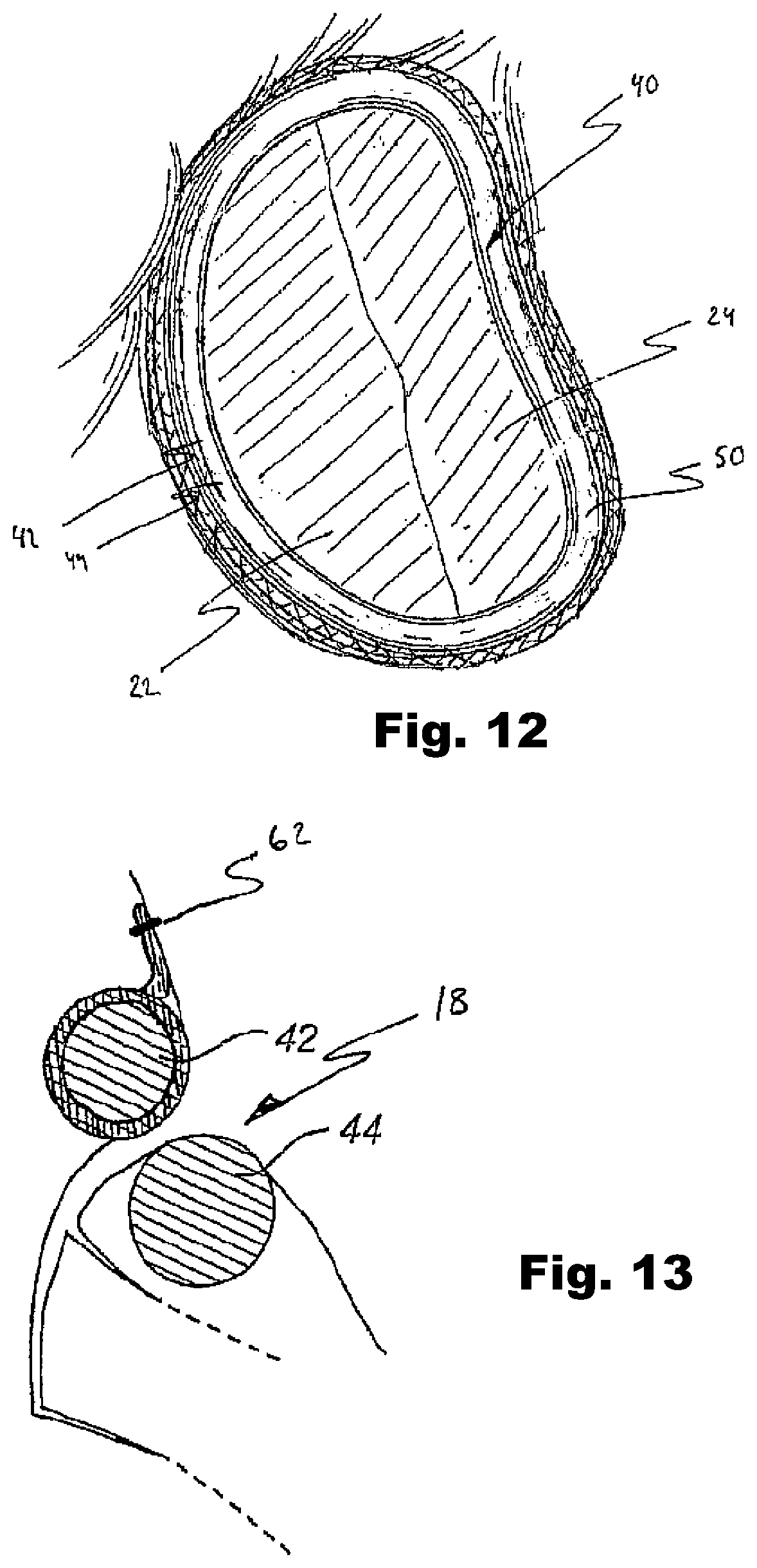 Patent US12324740 Figure 8 – Device and method for improving function of heart valve