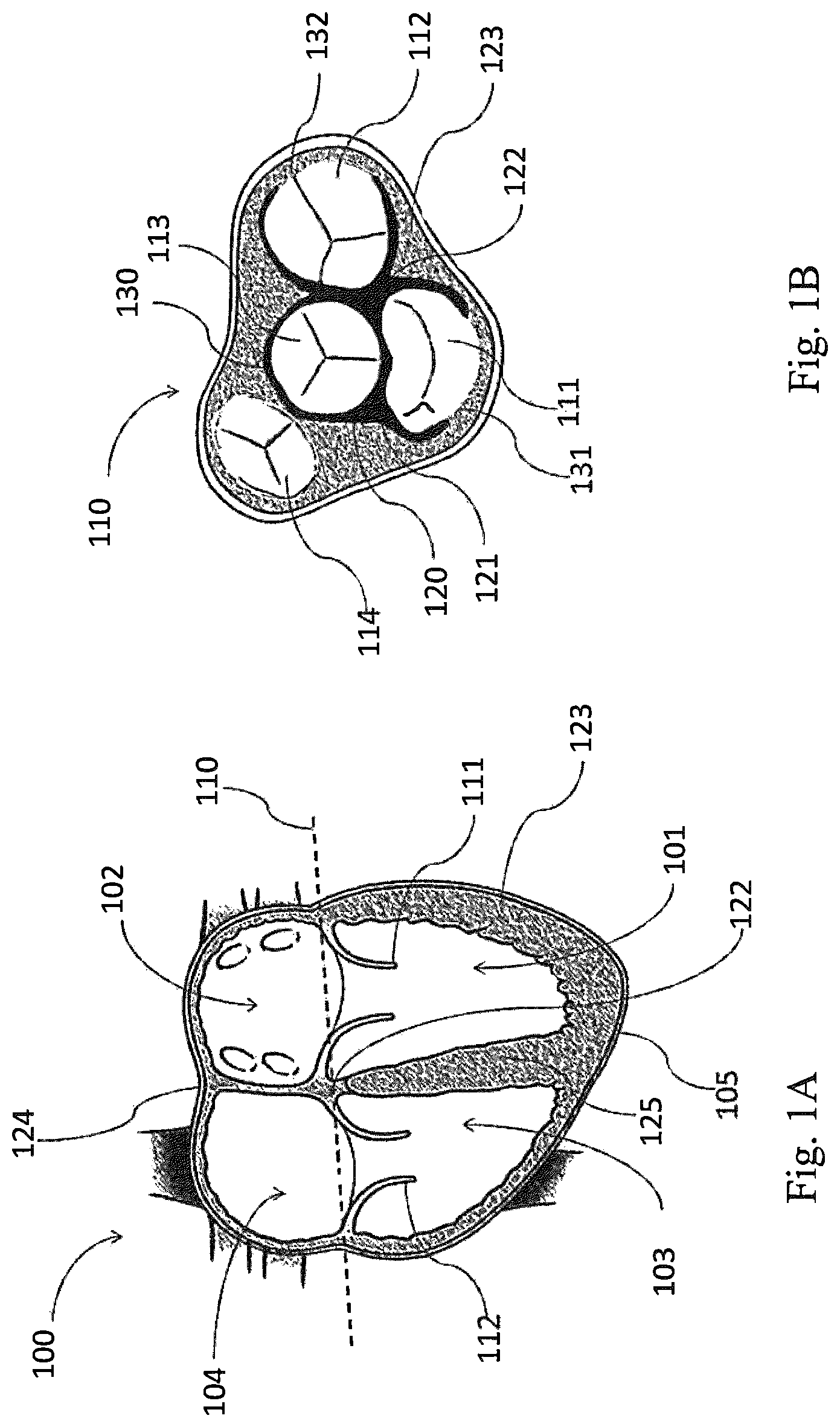 Patent US12324741 Figure 1 – Medical chamber system, introduction system and kit