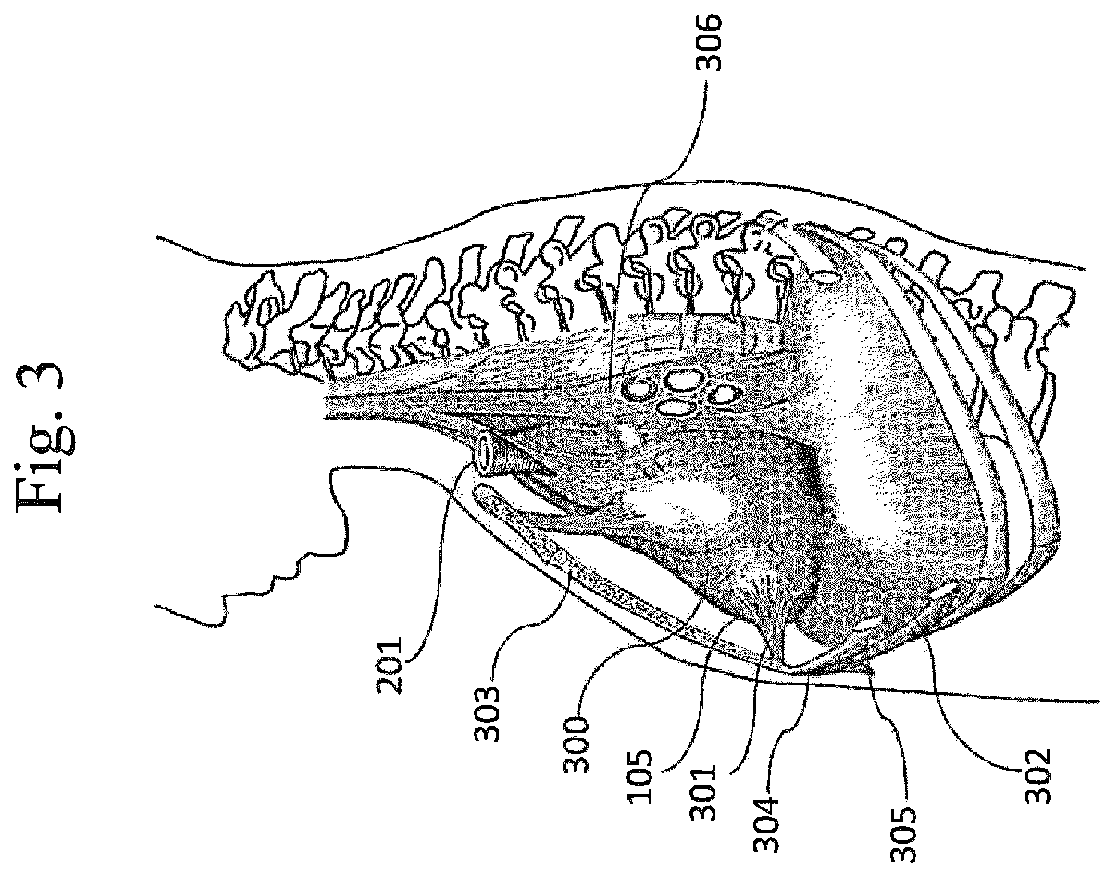 Patent US12324741 Figure 3 – Medical chamber system, introduction system and kit