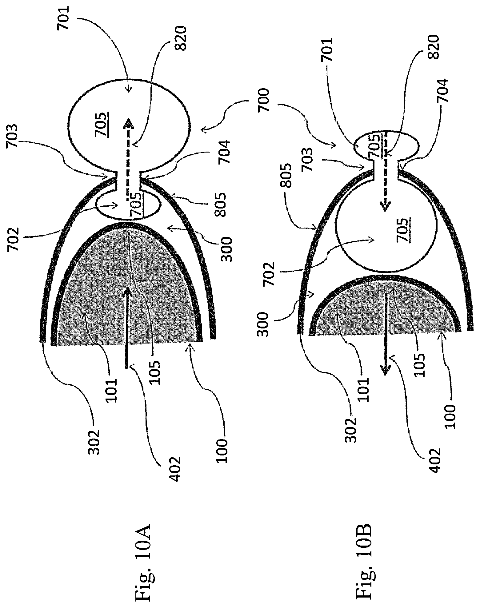 Patent US12324741 Figure 11 – Medical chamber system, introduction system and kit