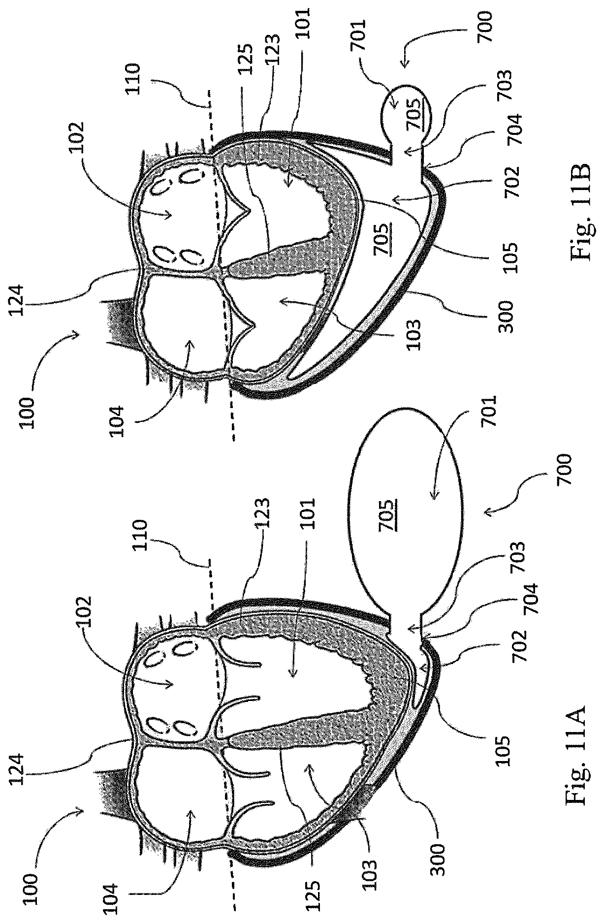 Patent US12324741 Figure 12 – Medical chamber system, introduction system and kit