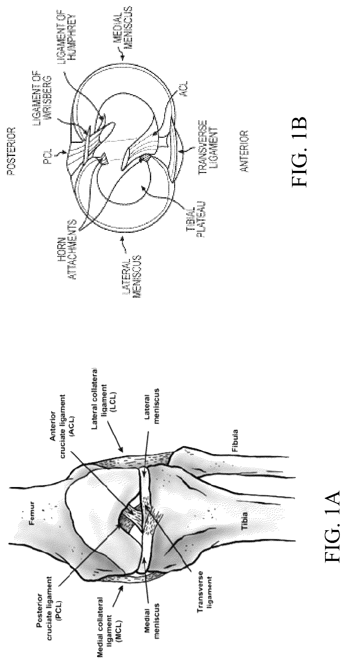 Patent US12324742 Figure 1 – Orthopedic implants having circumferential and non-circumferential fibers