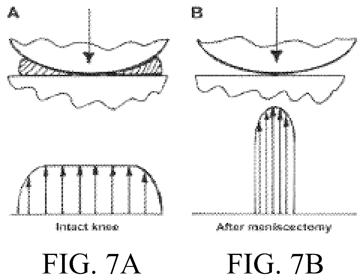 Patent US12324742 Figure 6 – Orthopedic implants having circumferential and non-circumferential fibers