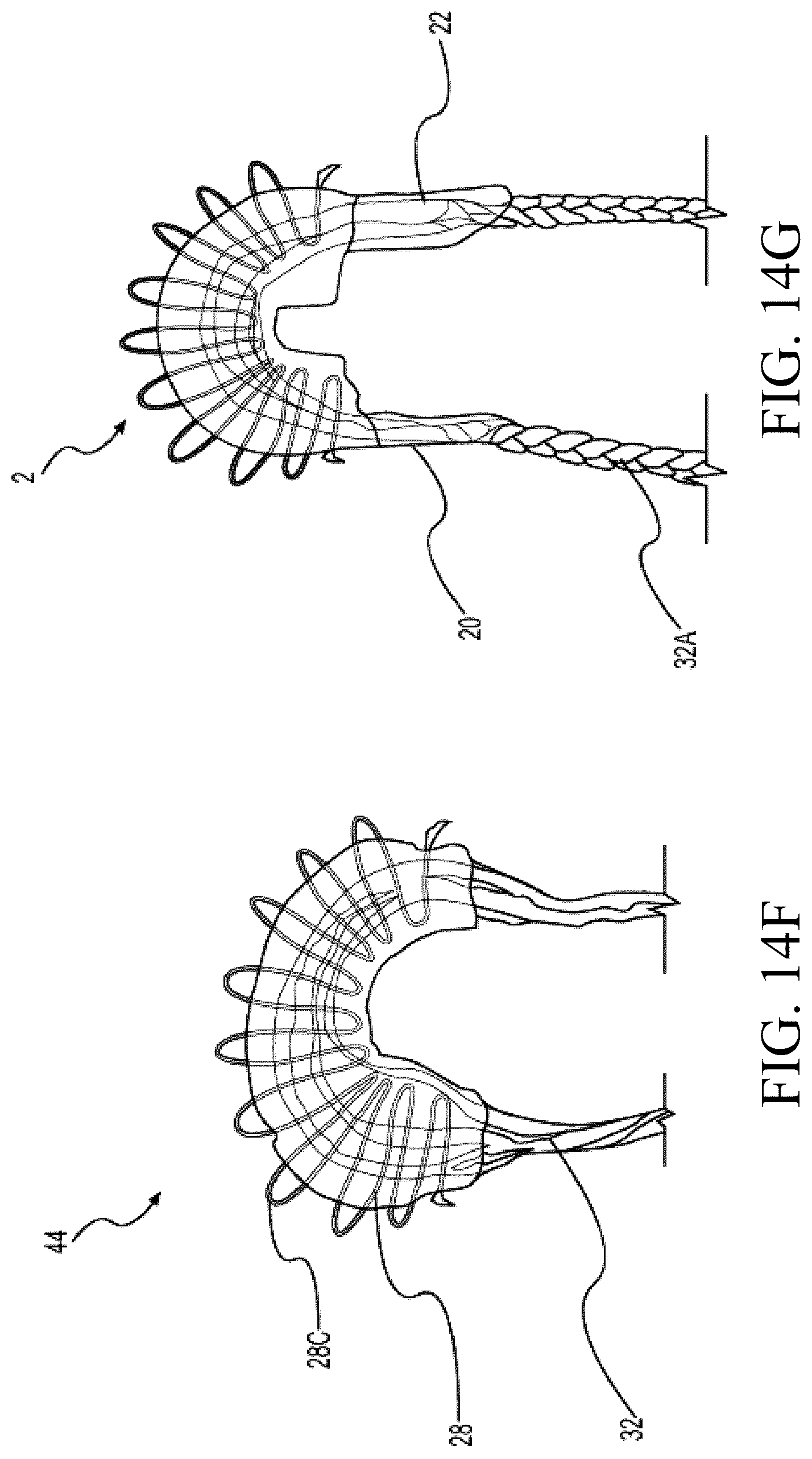 Patent US12324742 Figure 13 – Orthopedic implants having circumferential and non-circumferential fibers