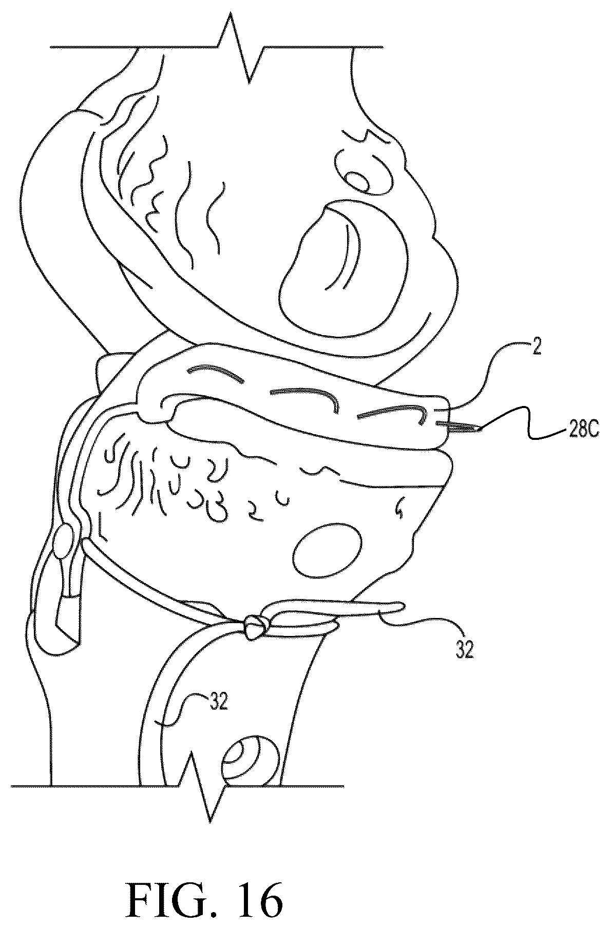 Patent US12324742 Figure 15 – Orthopedic implants having circumferential and non-circumferential fibers