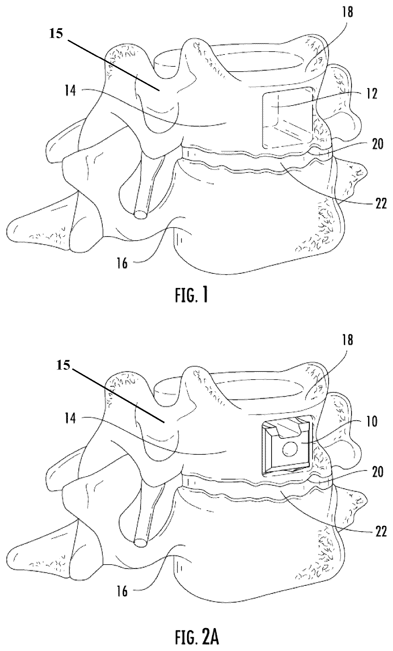 Patent US12324743 Figure 1 – Method and apparatus for placement of a vertebral body replacement device into a transcorporeal void during a surgical operation on the cervical portion of the spine