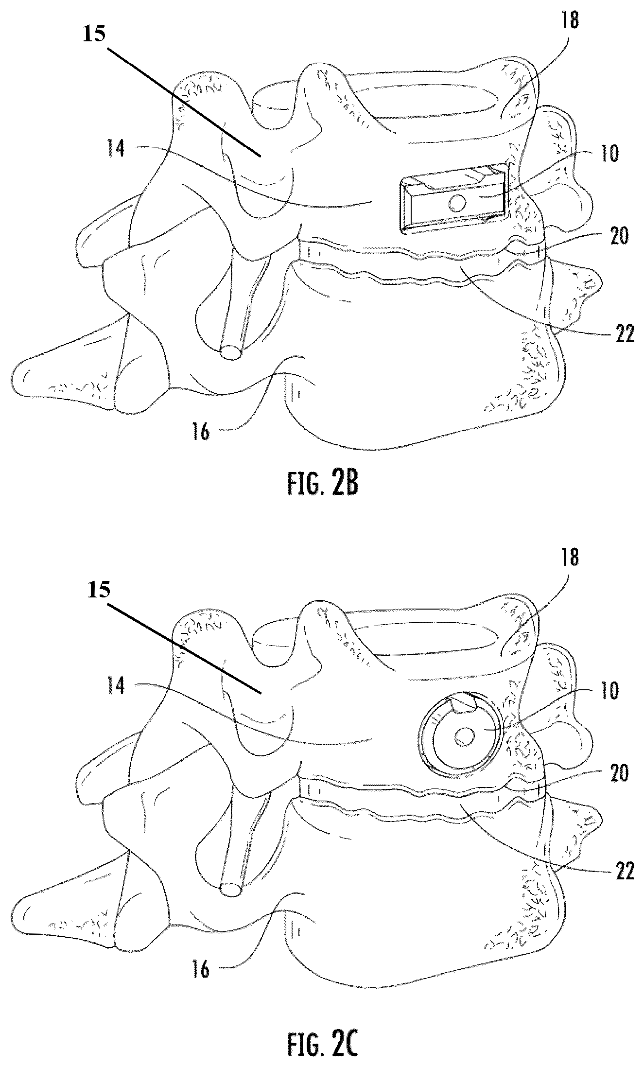 Patent US12324743 Figure 2 – Method and apparatus for placement of a vertebral body replacement device into a transcorporeal void during a surgical operation on the cervical portion of the spine
