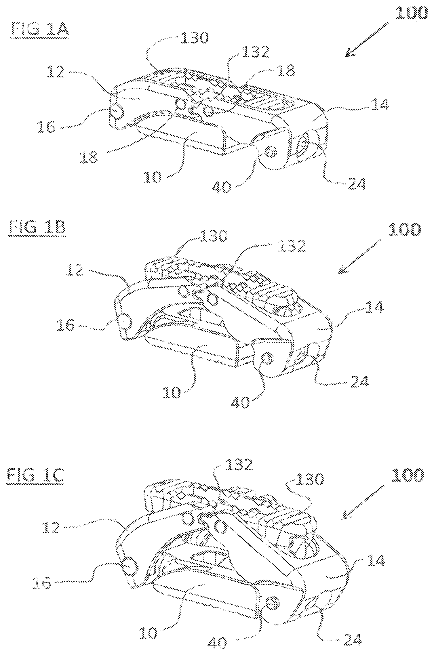 Patent US12324744 Figure 1 – Expandable implant with deflectable sequence of segments