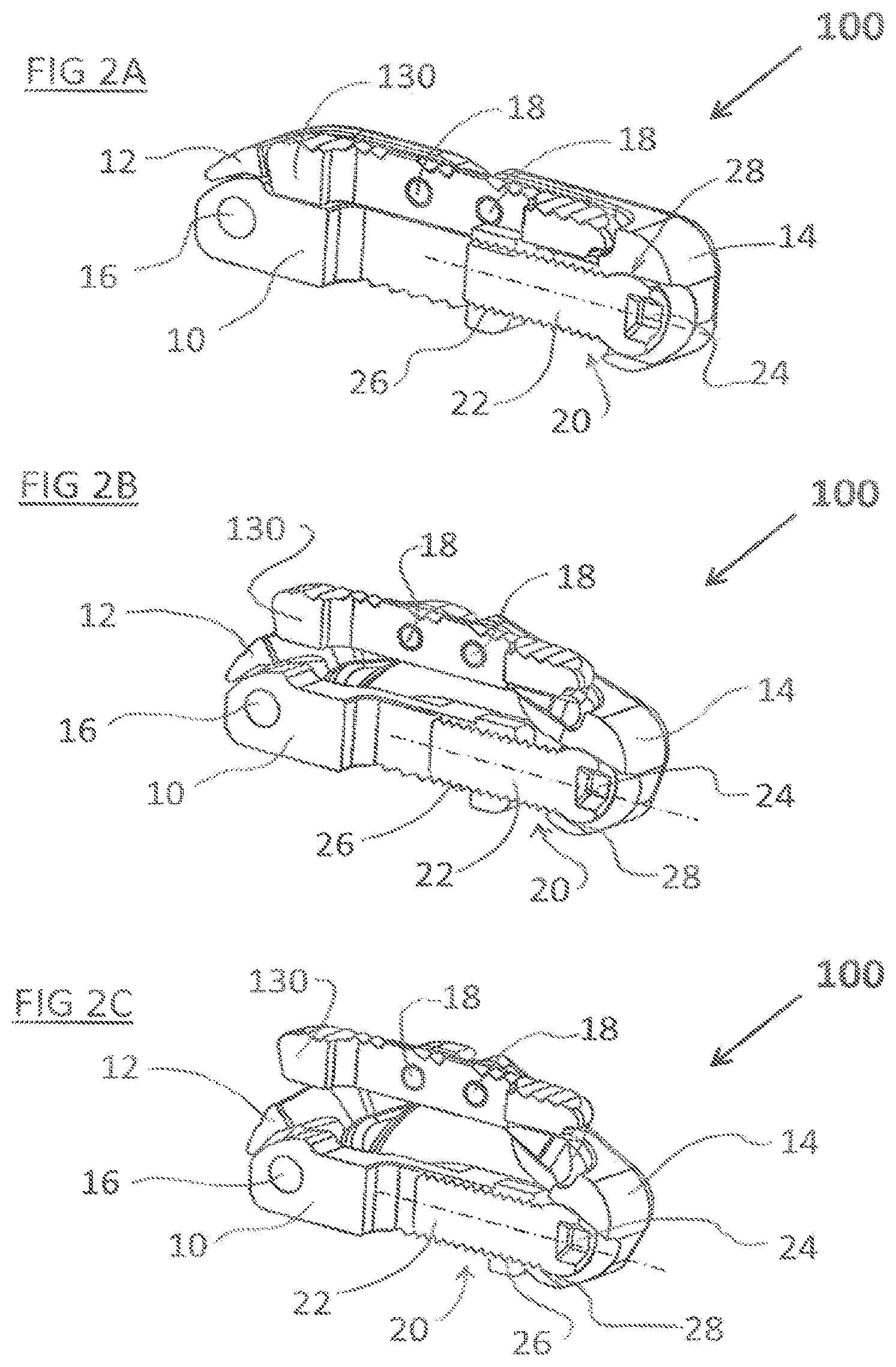 Patent US12324744 Figure 2 – Expandable implant with deflectable sequence of segments