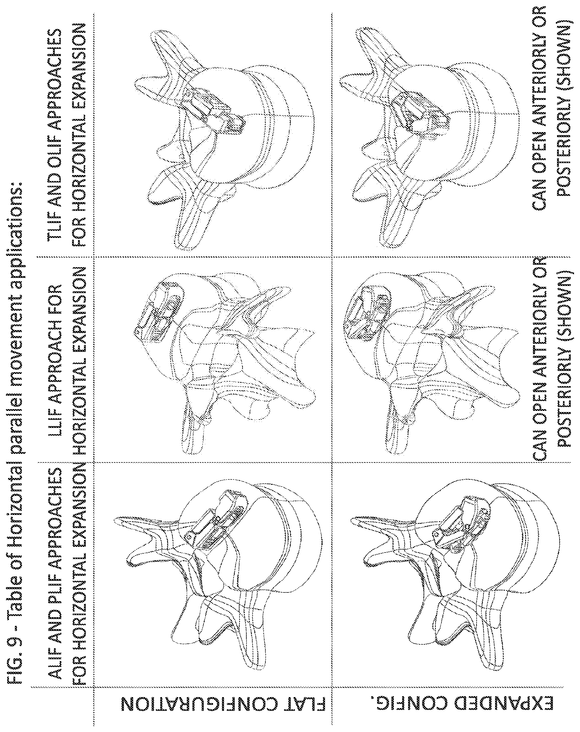 Patent US12324744 Figure 9 – Expandable implant with deflectable sequence of segments