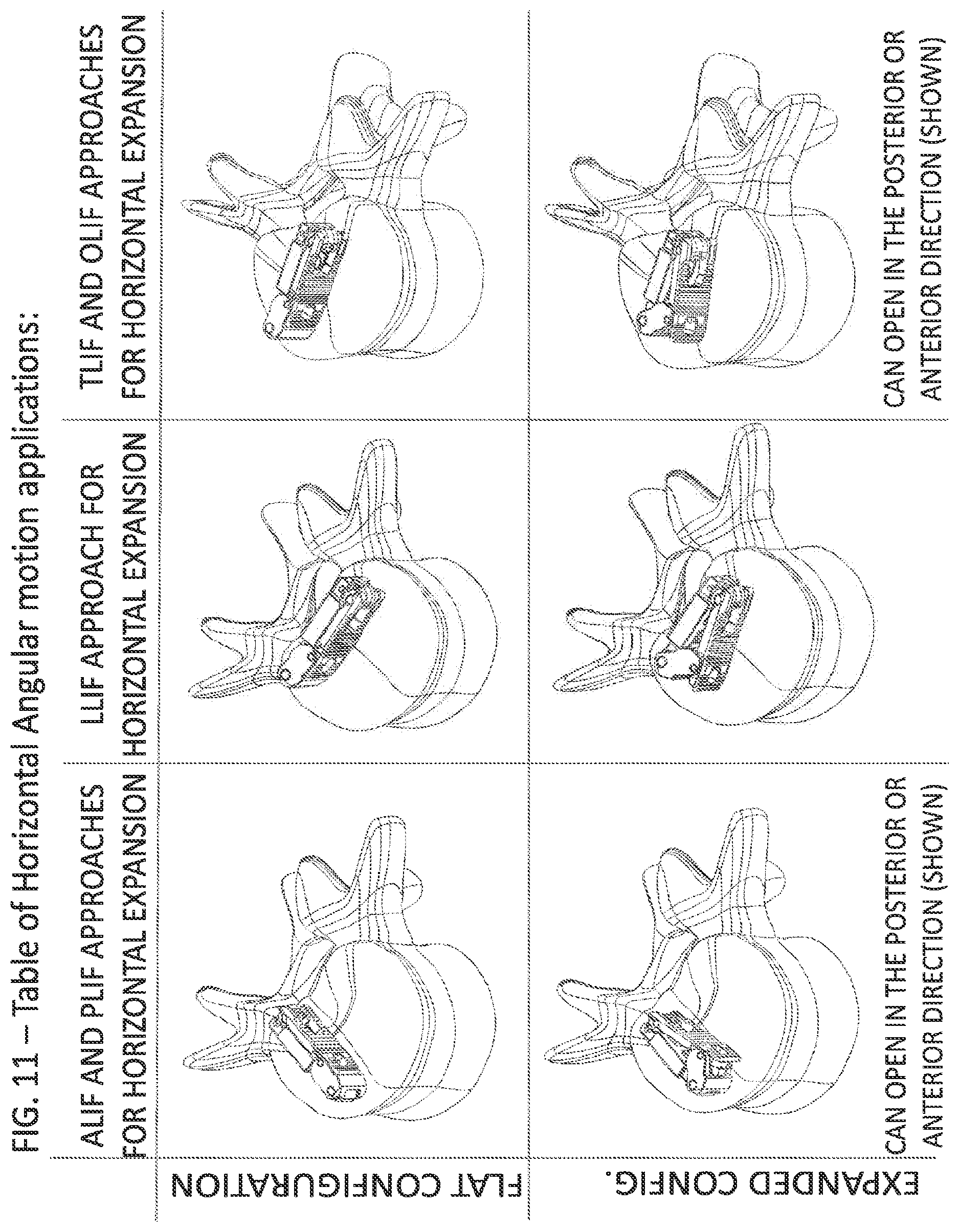 Patent US12324744 Figure 11 – Expandable implant with deflectable sequence of segments